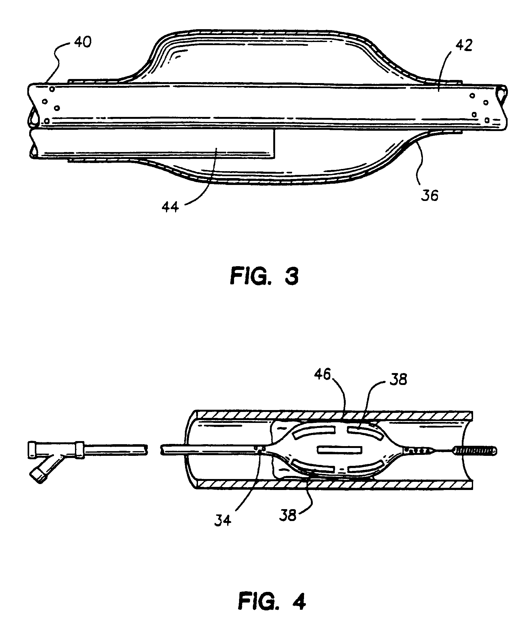 Apparatus for restenosis treatment