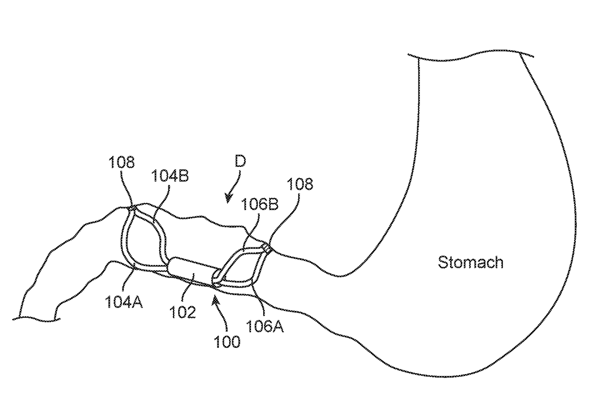 Temporarily Implantable GI Sensor and Stimulator and Related Methods