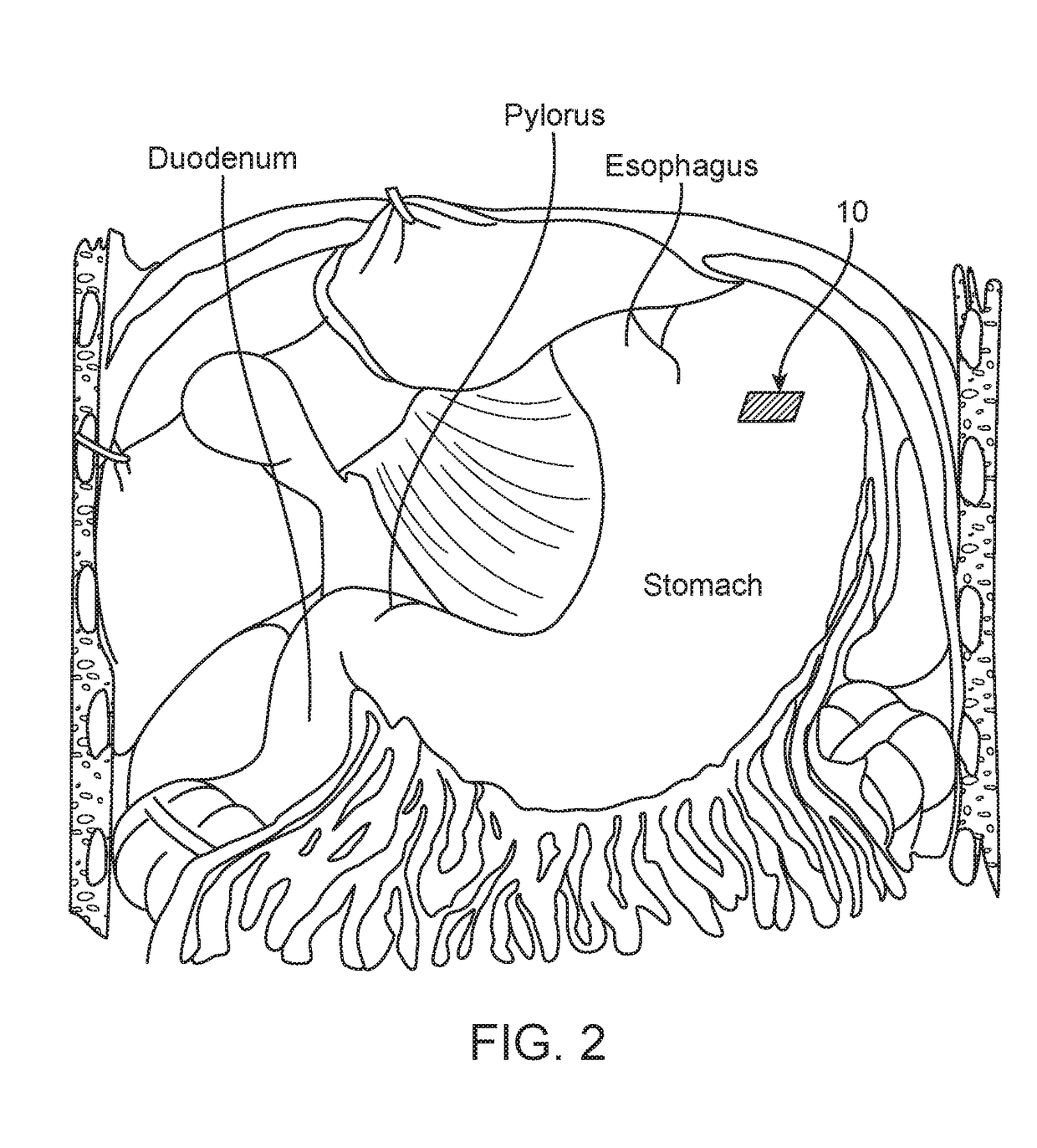 Temporarily Implantable GI Sensor and Stimulator and Related Methods