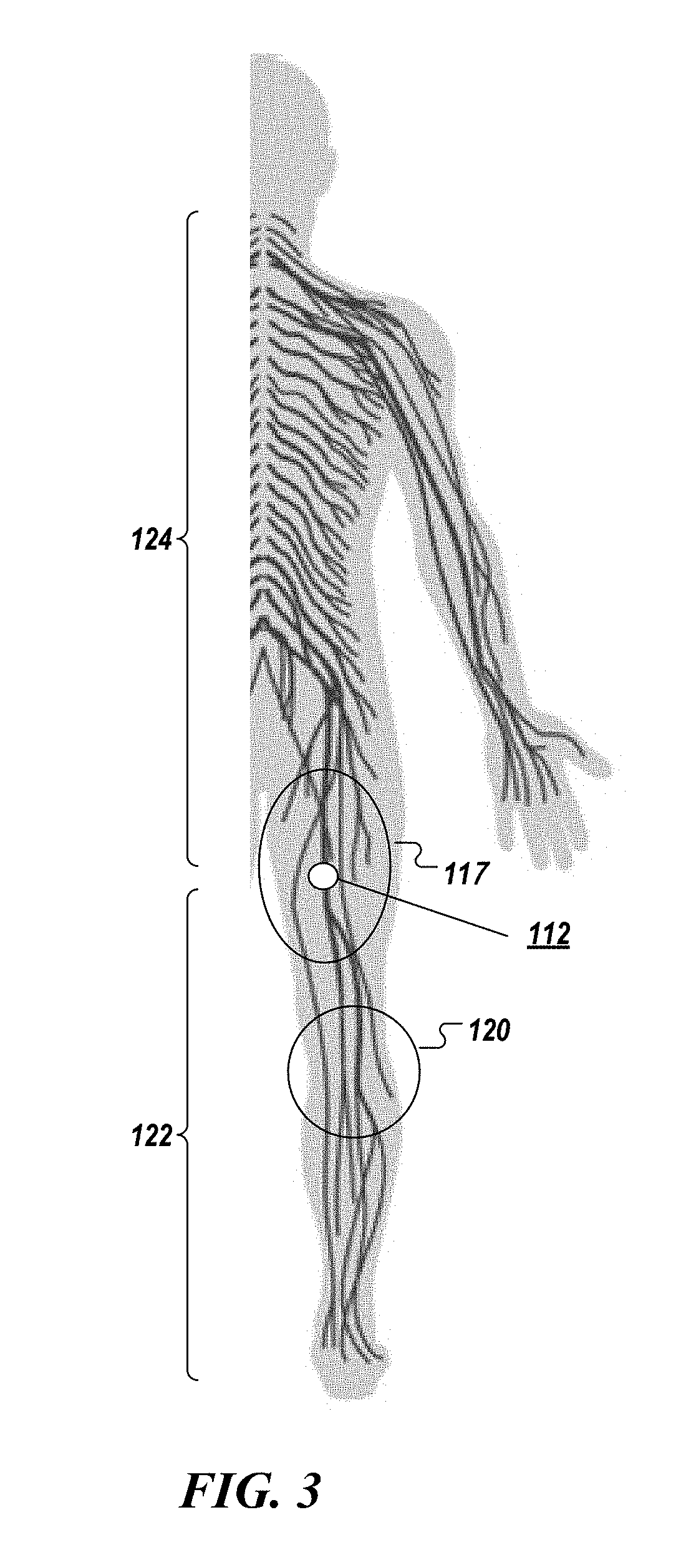 Percutaneous lead