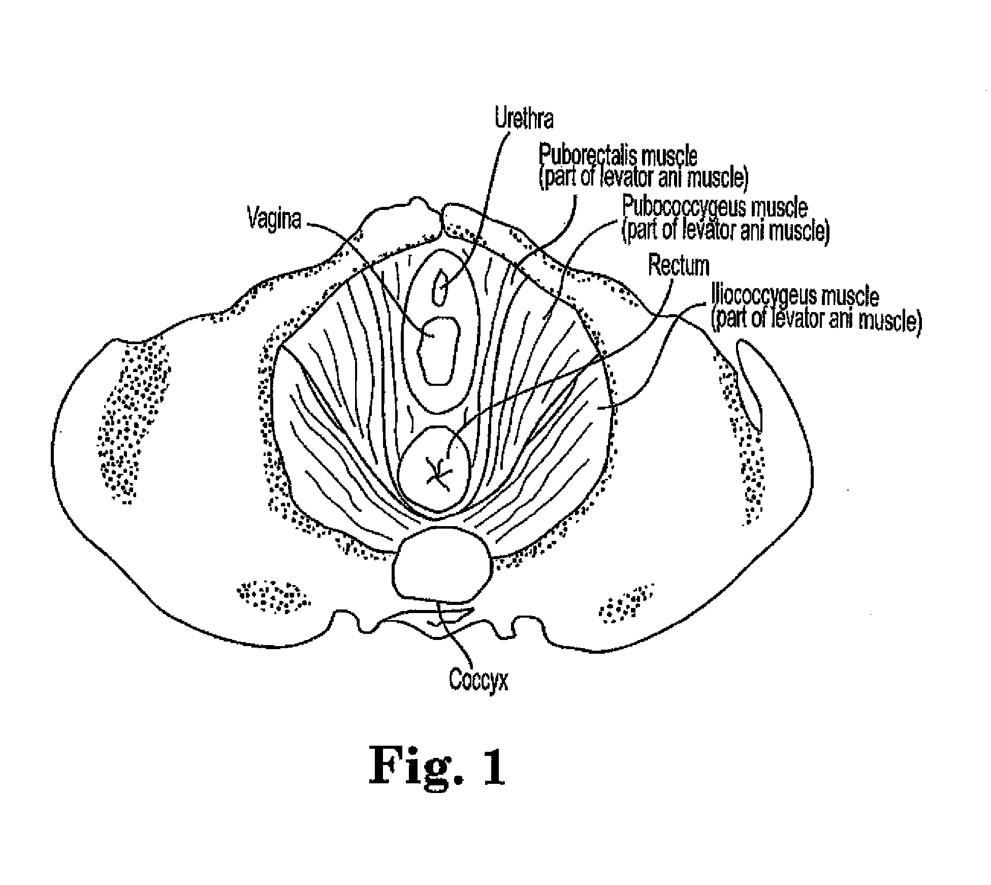 Levator for repair of perineal prolapse