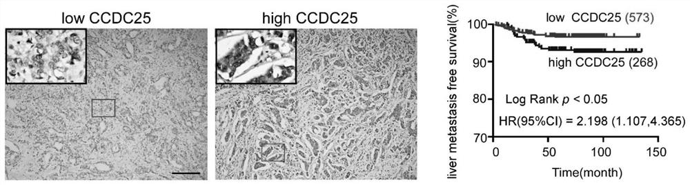 Application of ccdc25 in predicting breast cancer prognosis and inhibiting distant organ metastasis of breast cancer