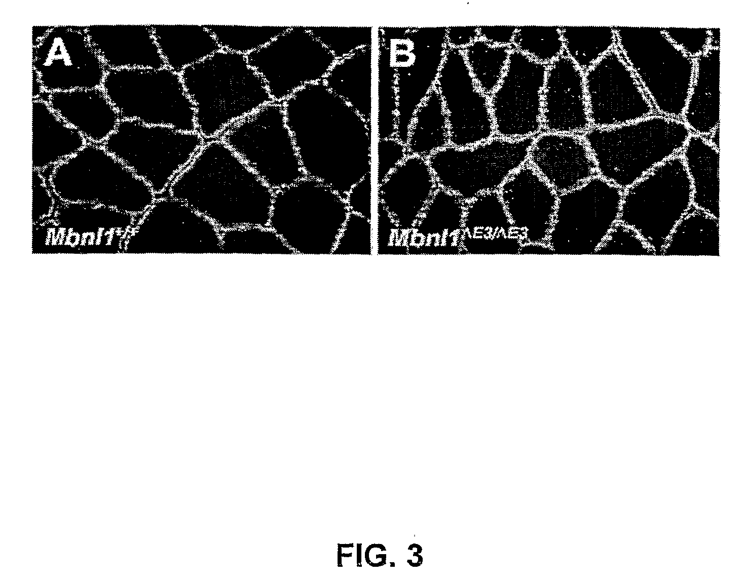 Methods and Compositions for Treatment of Diseases Associated with Aberrant Microsatellite Expansion