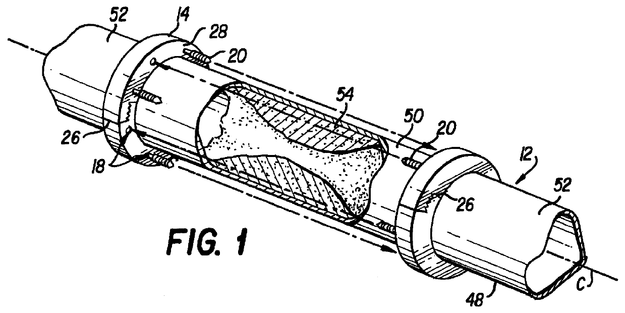 Anastomosis apparatus and method for anastomosing an anatomical tubular structure