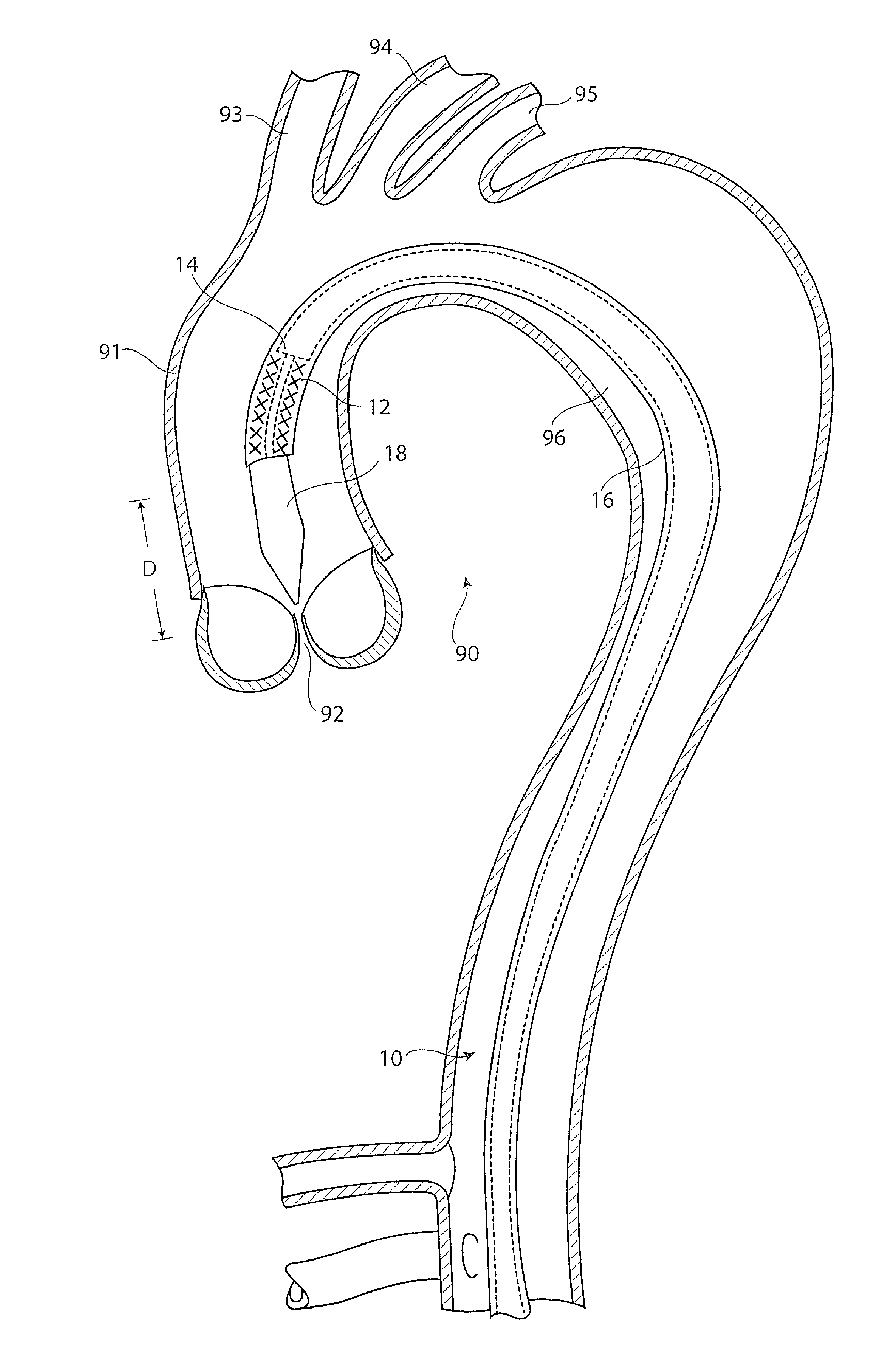 Introducer Assembly and Dilator Tip Therefor