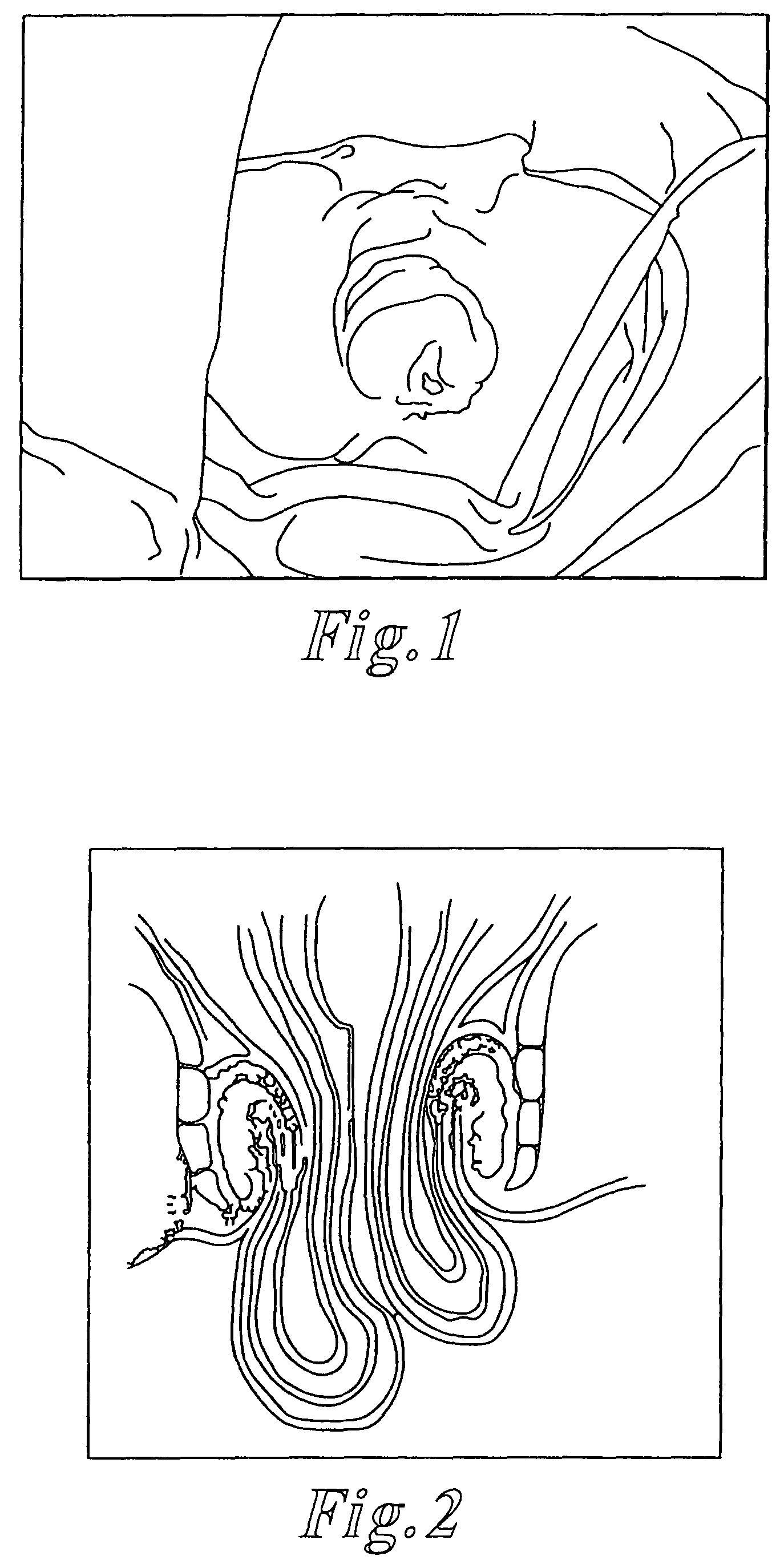 Methods and articles for treatment of rectal prolapse