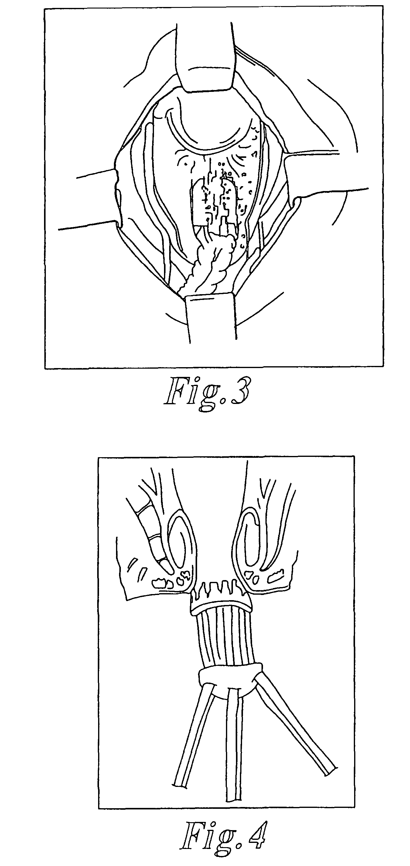 Methods and articles for treatment of rectal prolapse