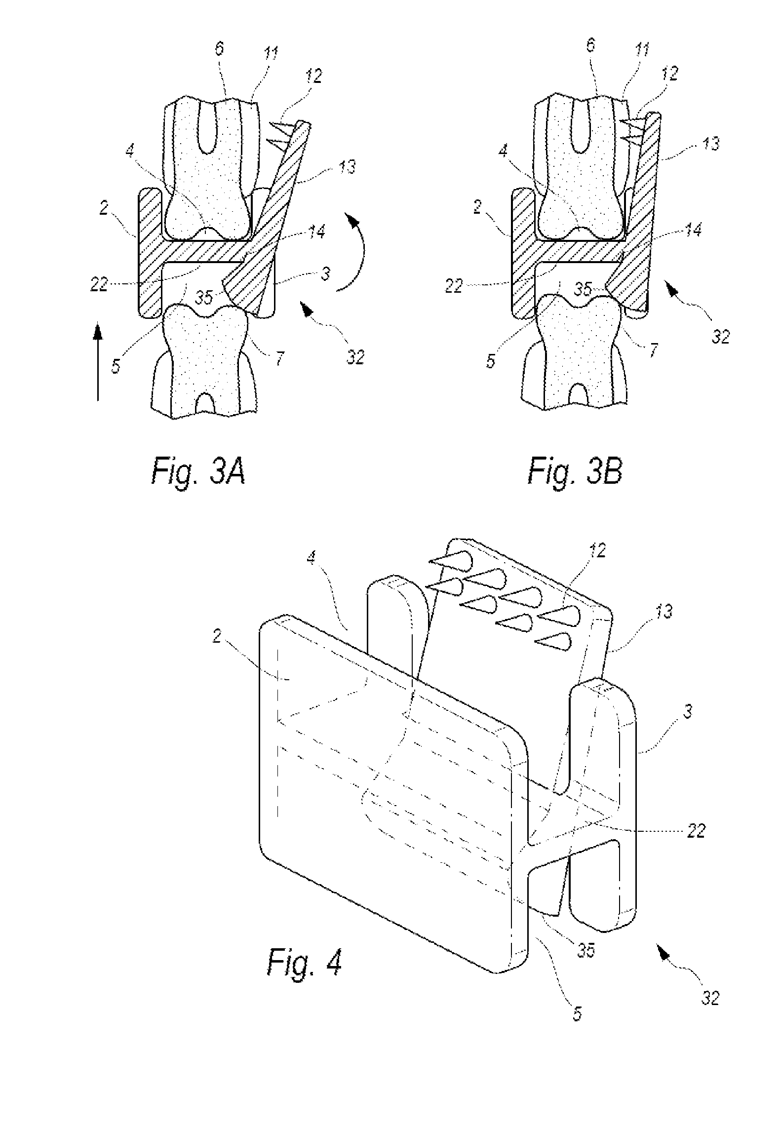 Device and Methods for Treatment of Temporomandibular Joint (TMJ) Disorder