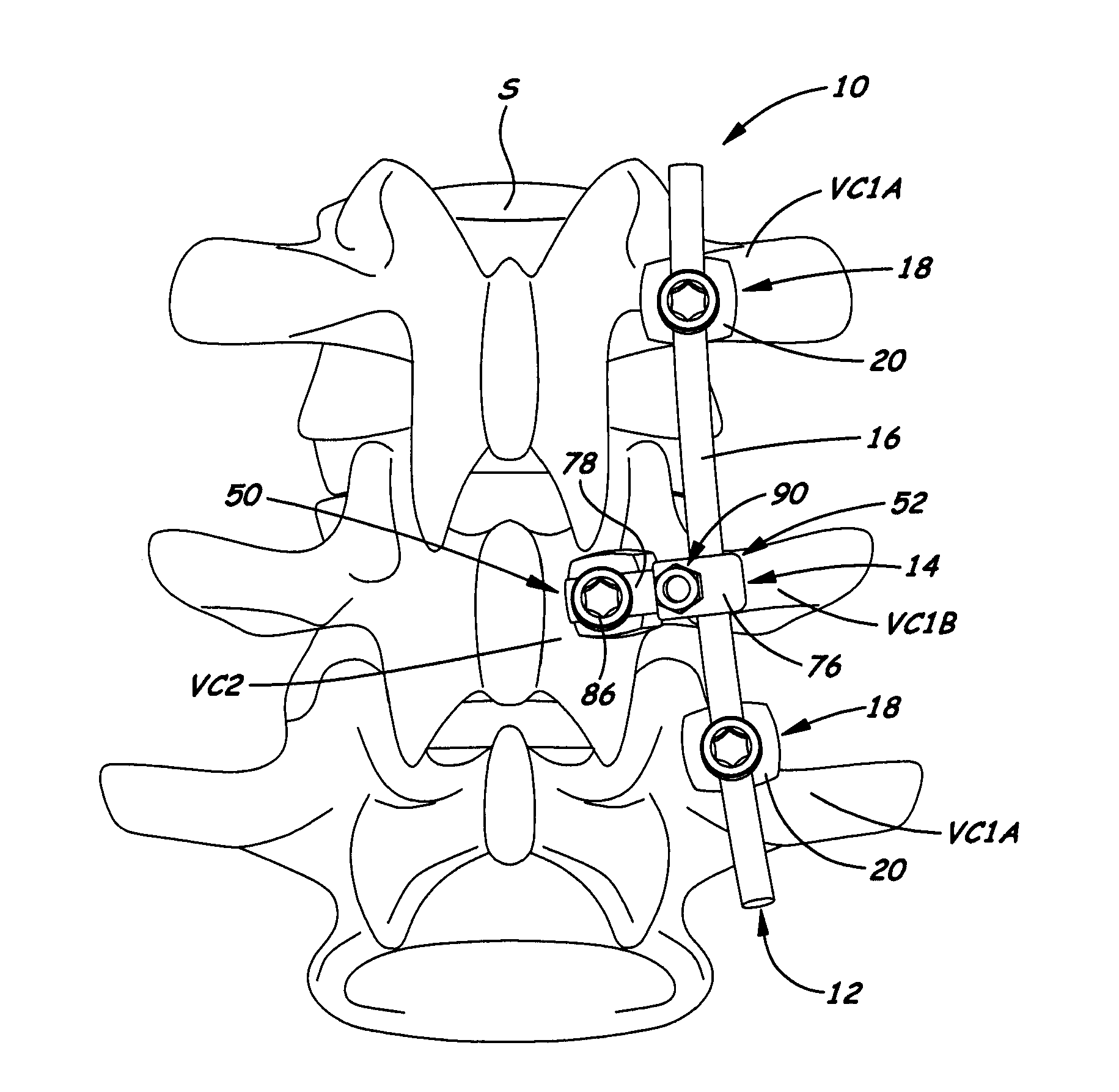 Apparatus for implementing a spinal fixation system with supplemental fixation