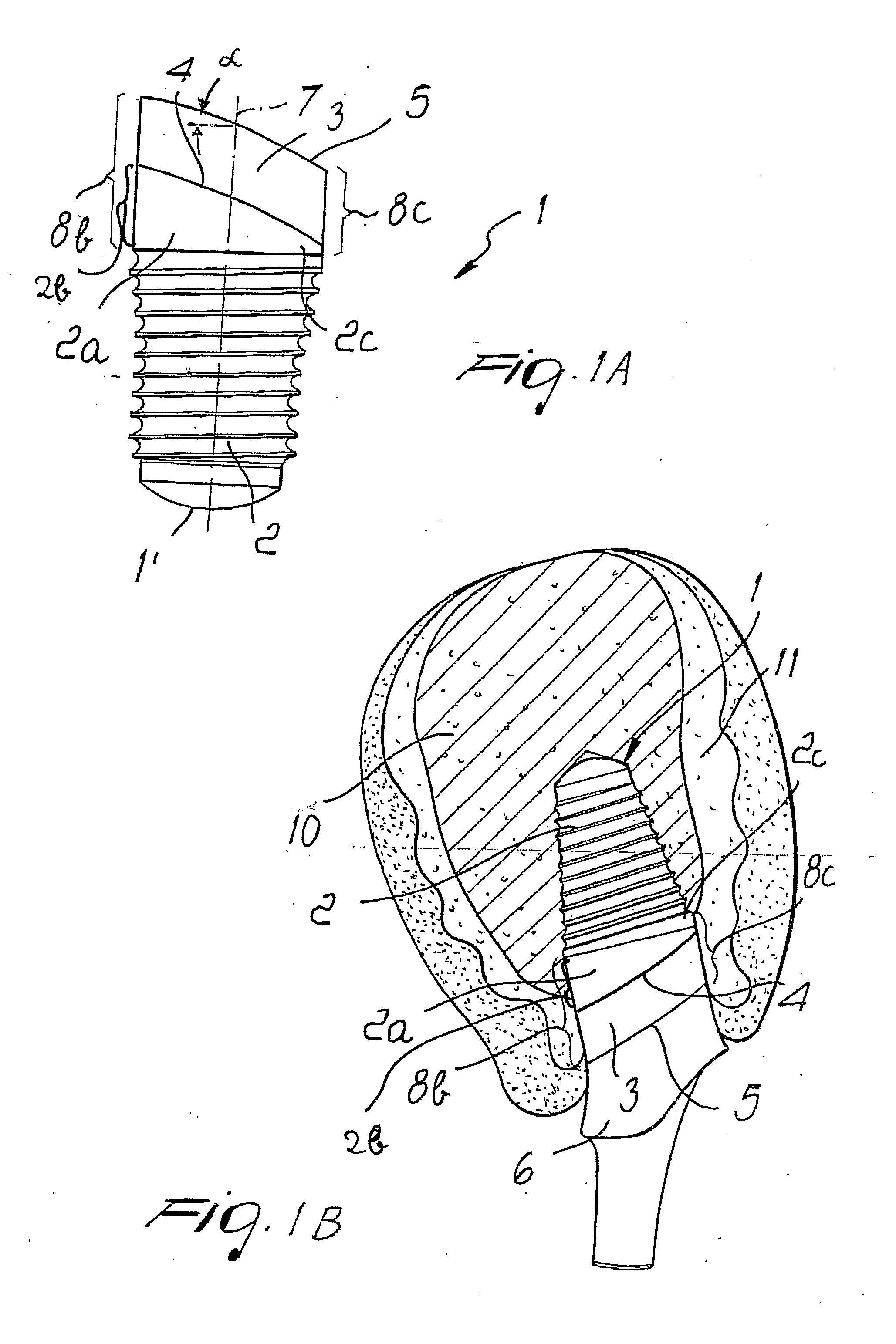 Dental implant with positioning means