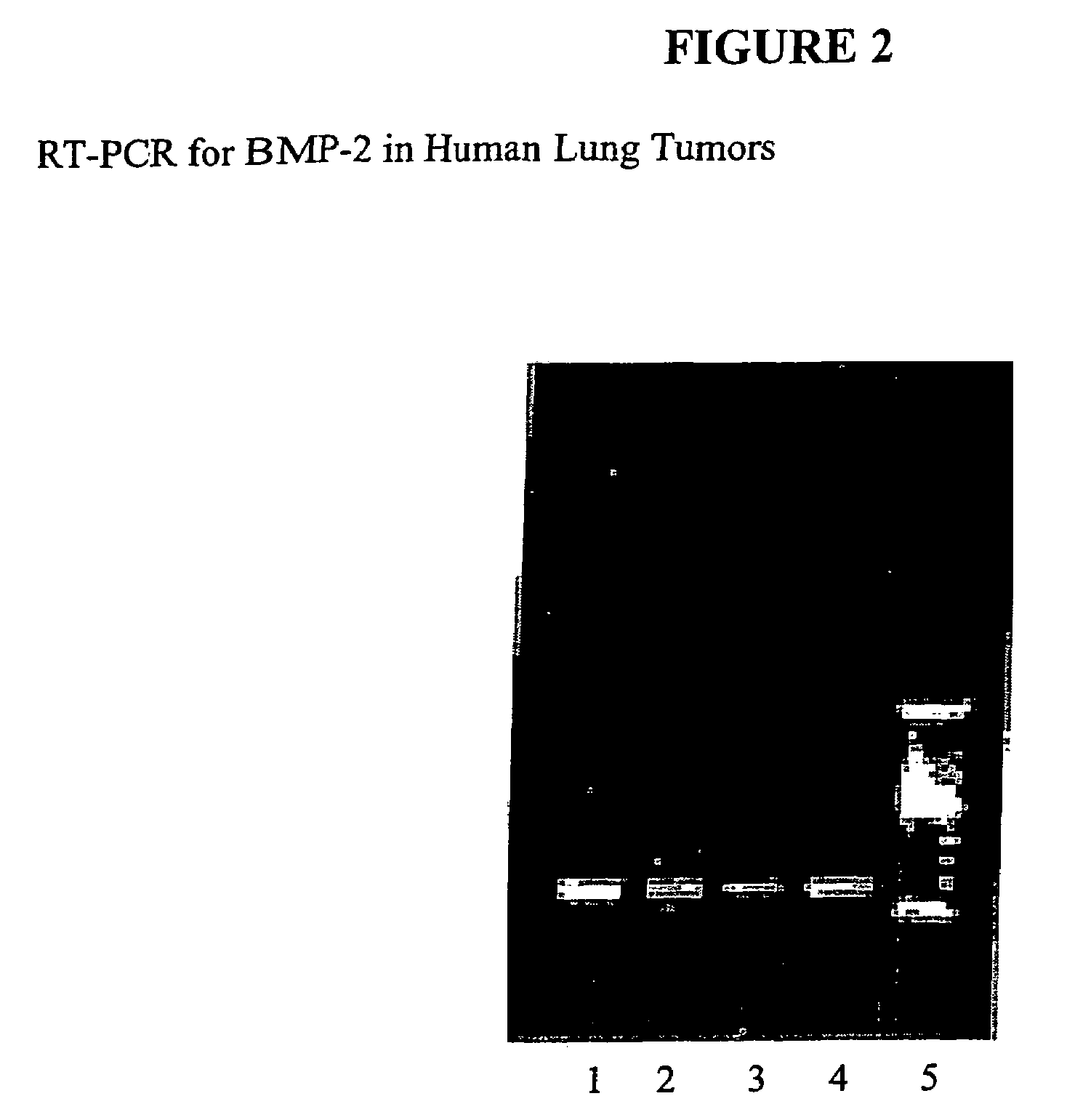 Bone morphogenetic protein-2 in the treatment and diagnosis of cancer