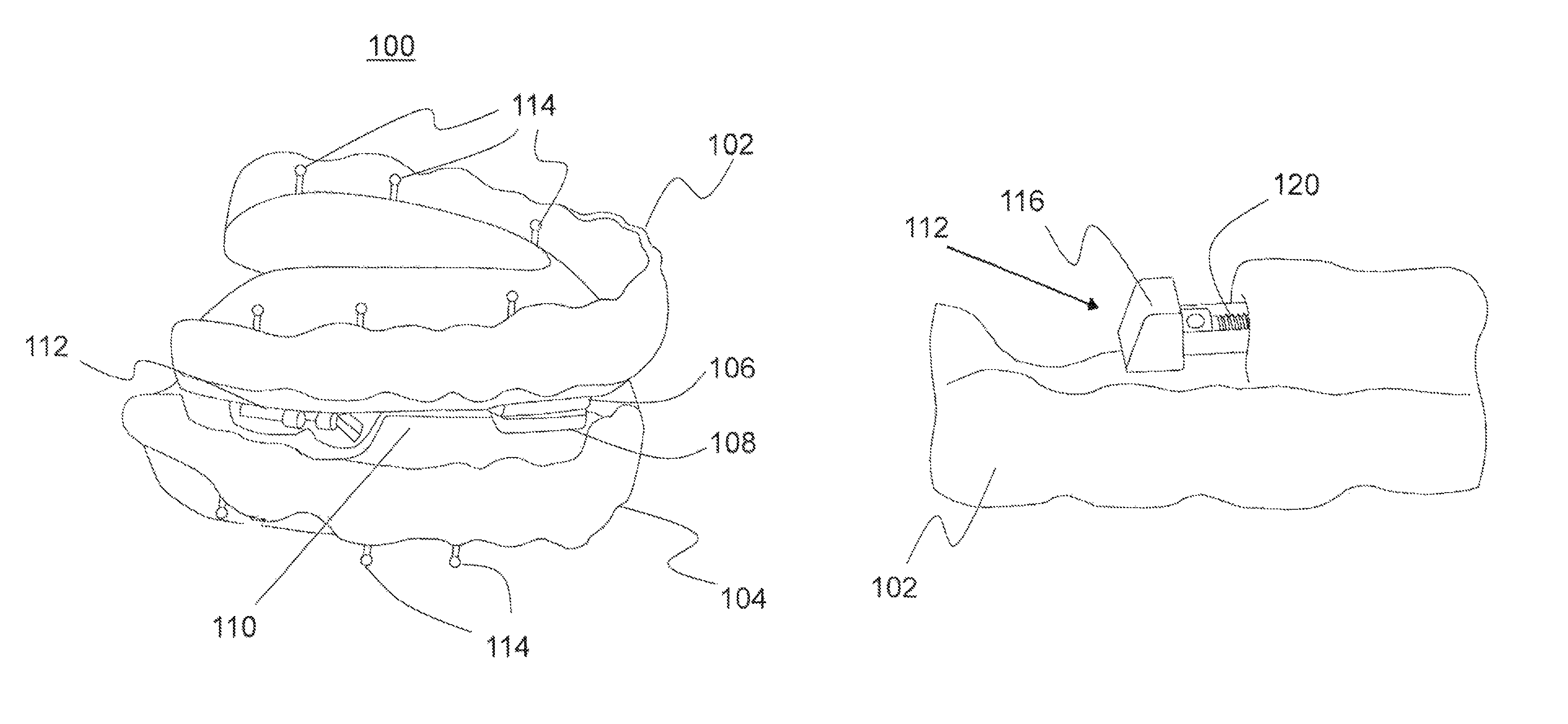 Adjustable mandibular advancement device