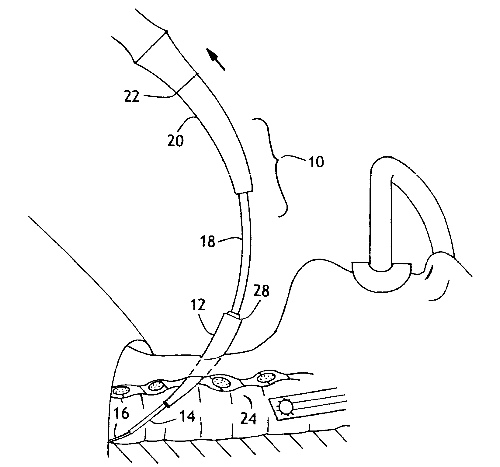 Dilator Loading Catheter