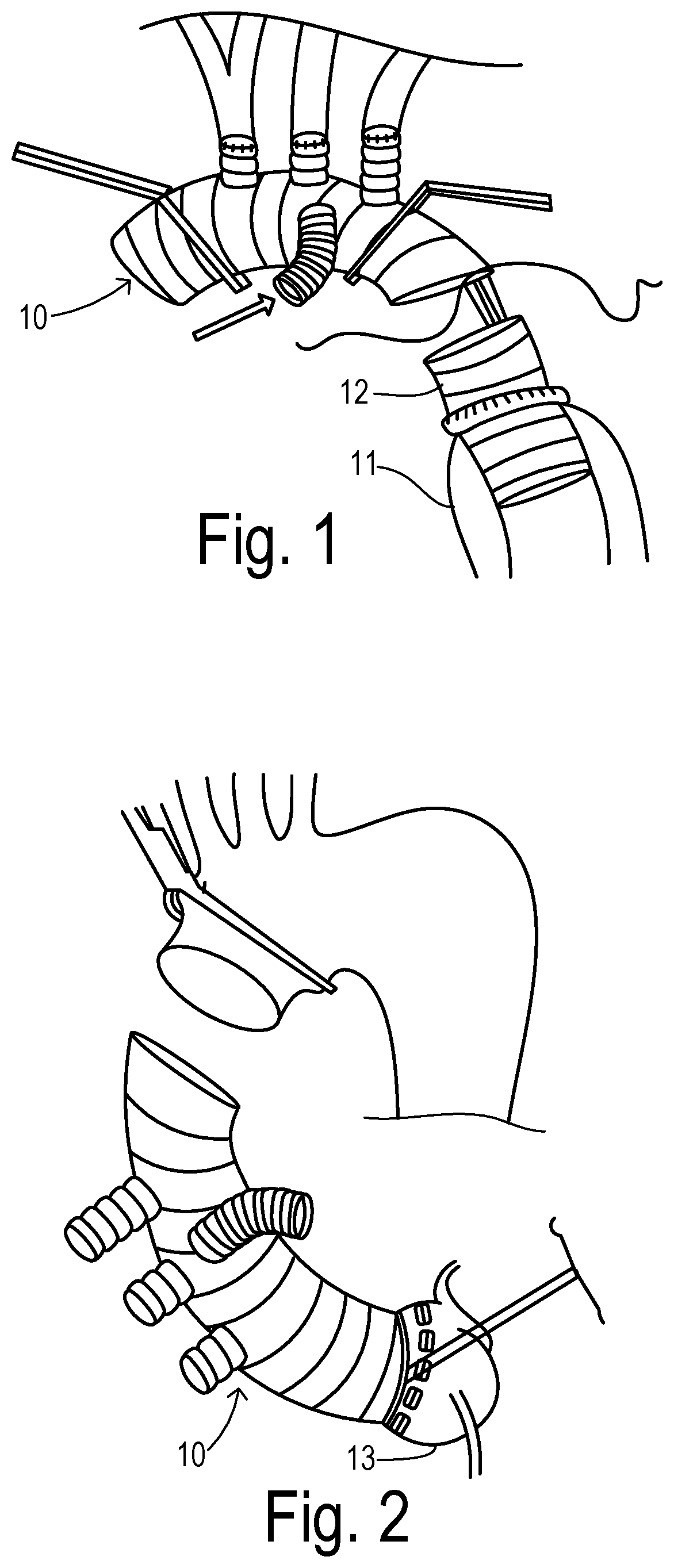 Great vessel graft suturing aid