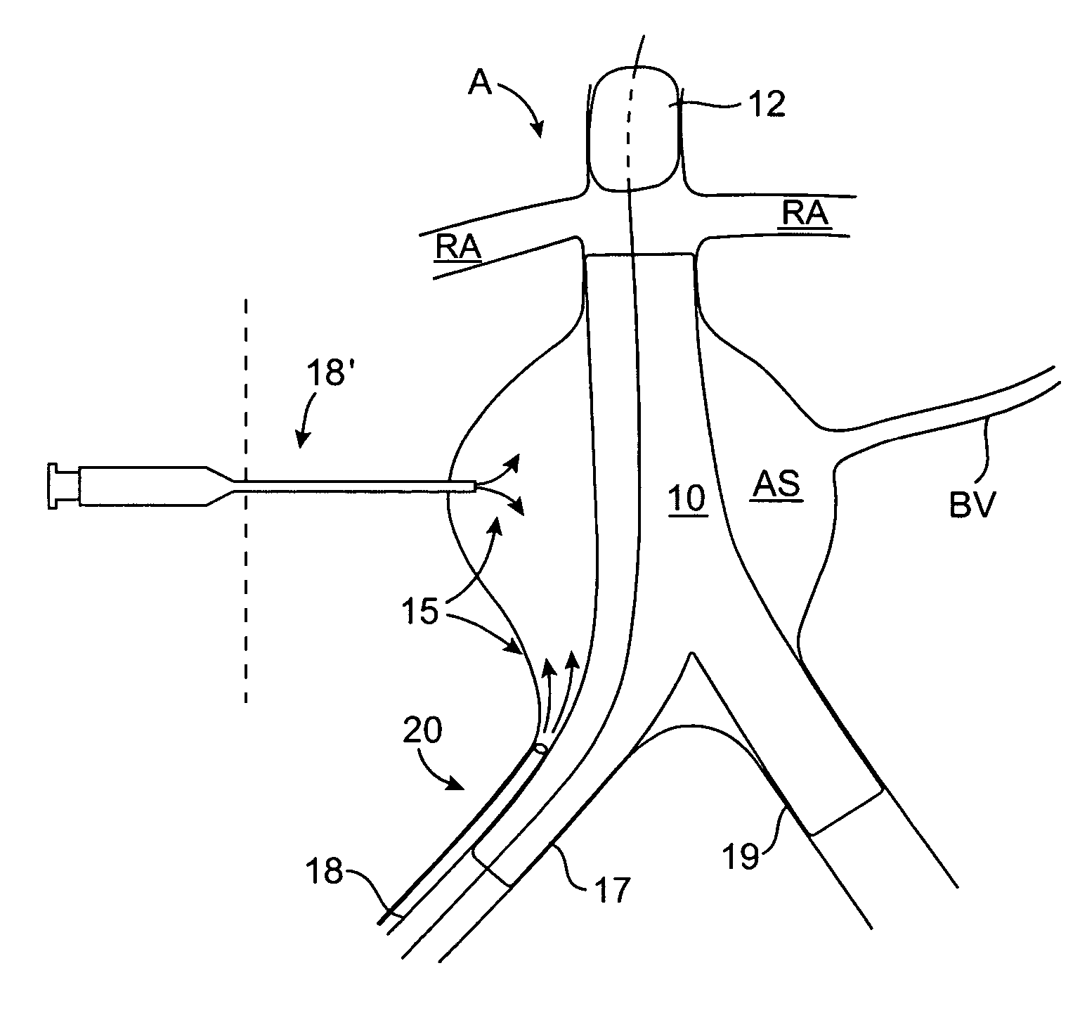 Endoluminal prosthesis endoleak management