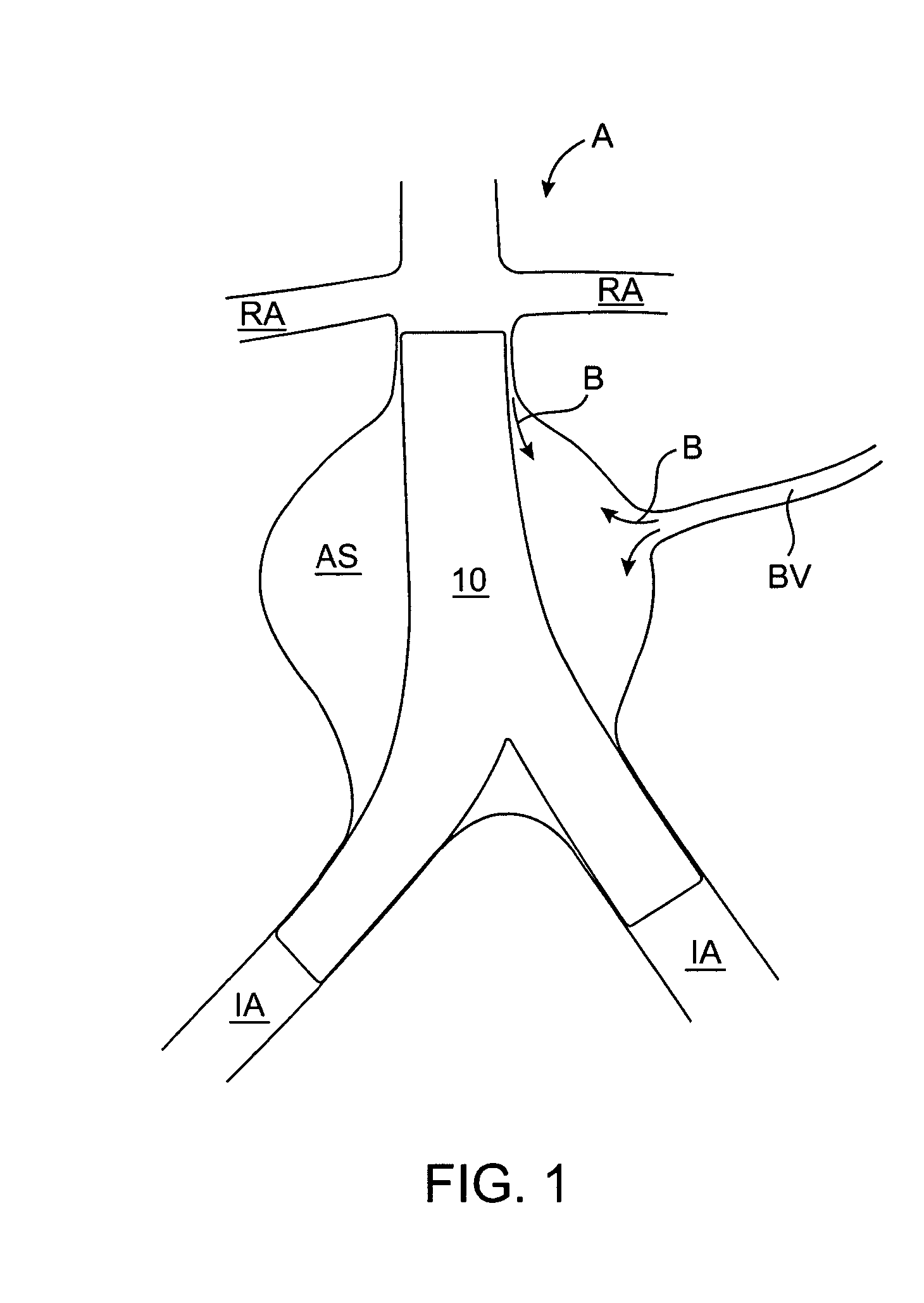 Endoluminal prosthesis endoleak management