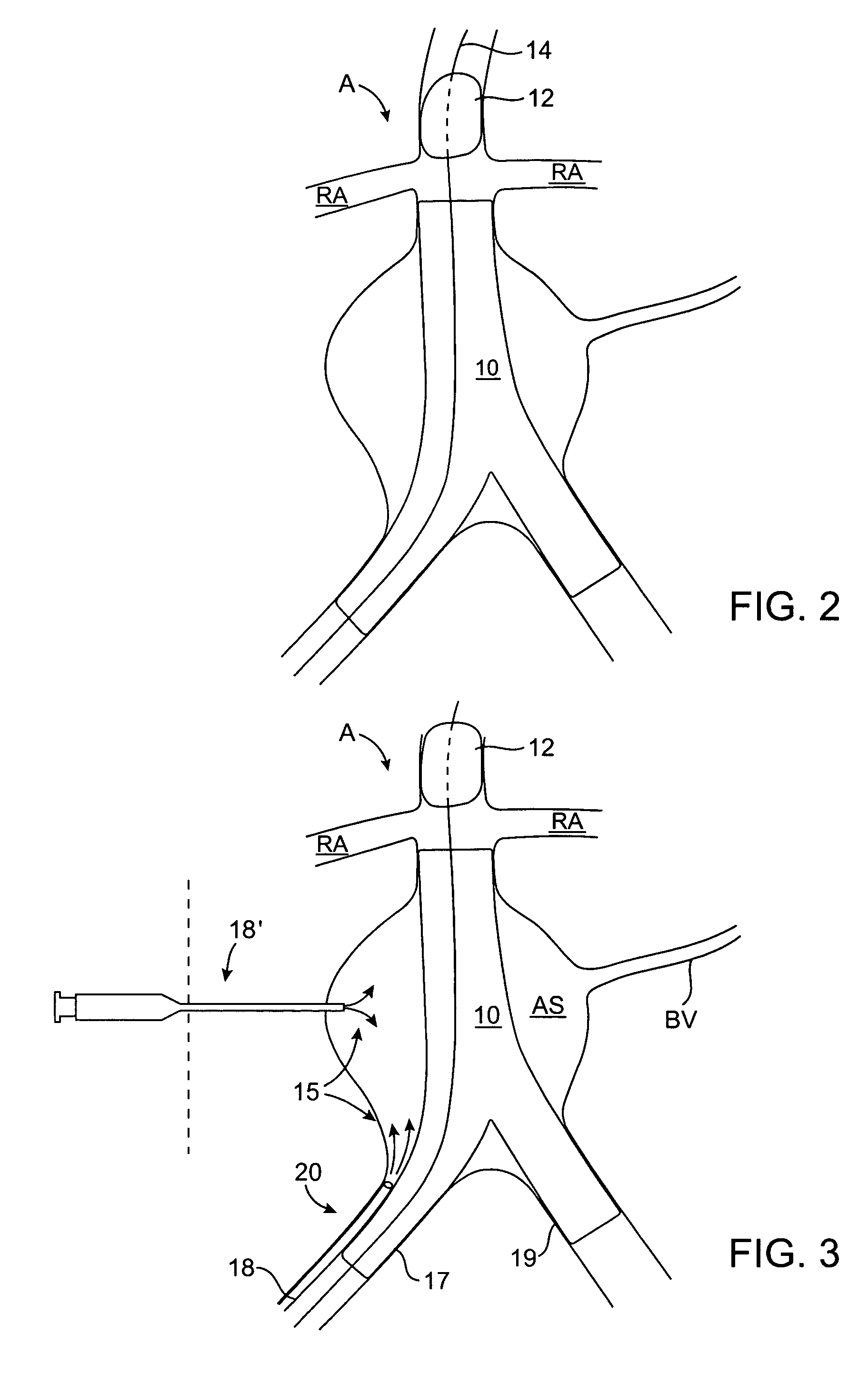 Endoluminal prosthesis endoleak management