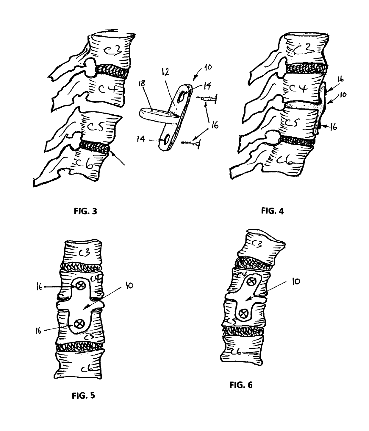 Artificial intervertebral disc implant device