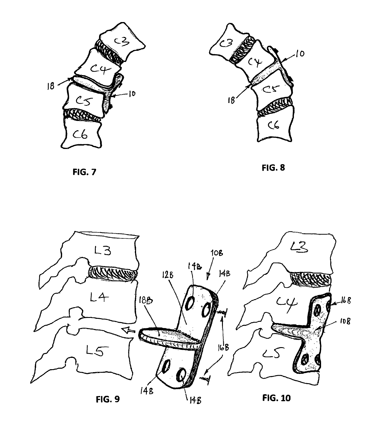 Artificial intervertebral disc implant device