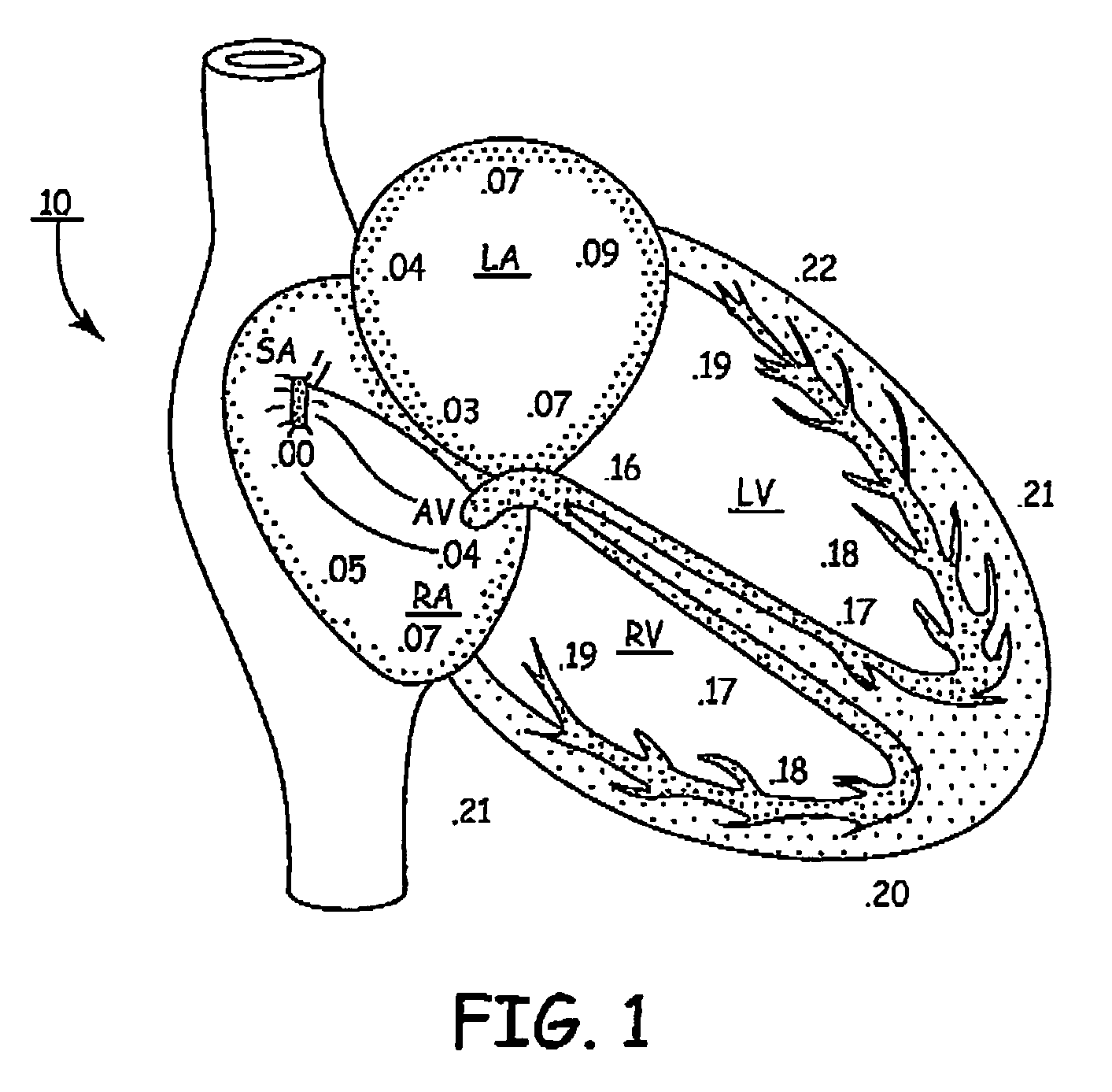 Bi-ventricular ventricular capture management in cardiac resyncronization therapy delivery devices