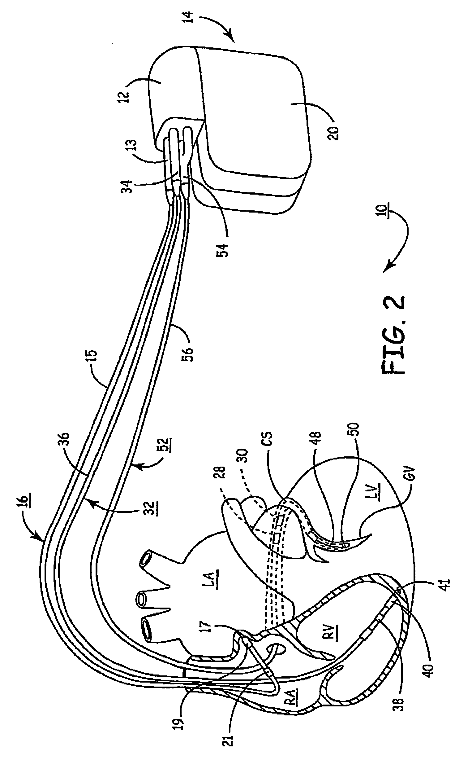 Bi-ventricular ventricular capture management in cardiac resyncronization therapy delivery devices