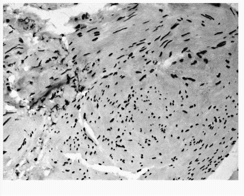 Application of DKK4 gene and coding protein thereof in preparation of medicament