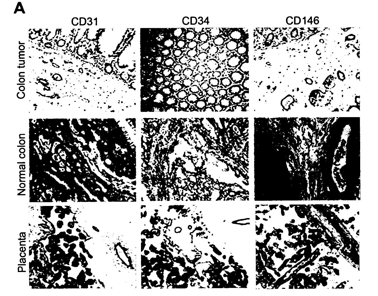 Tumor angiogenesis associated genes and a method for their identification