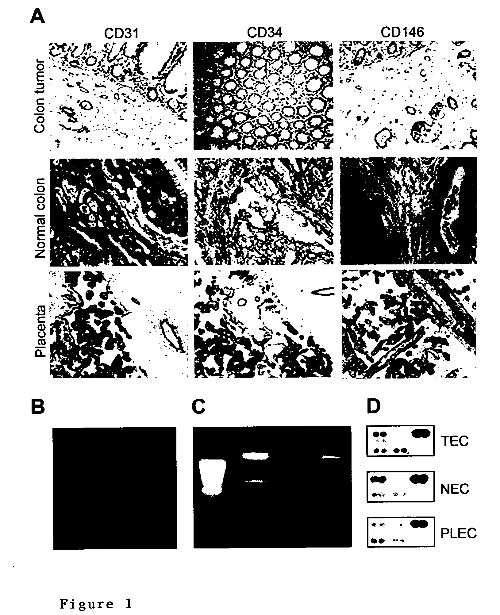 Tumor angiogenesis associated genes and a method for their identification