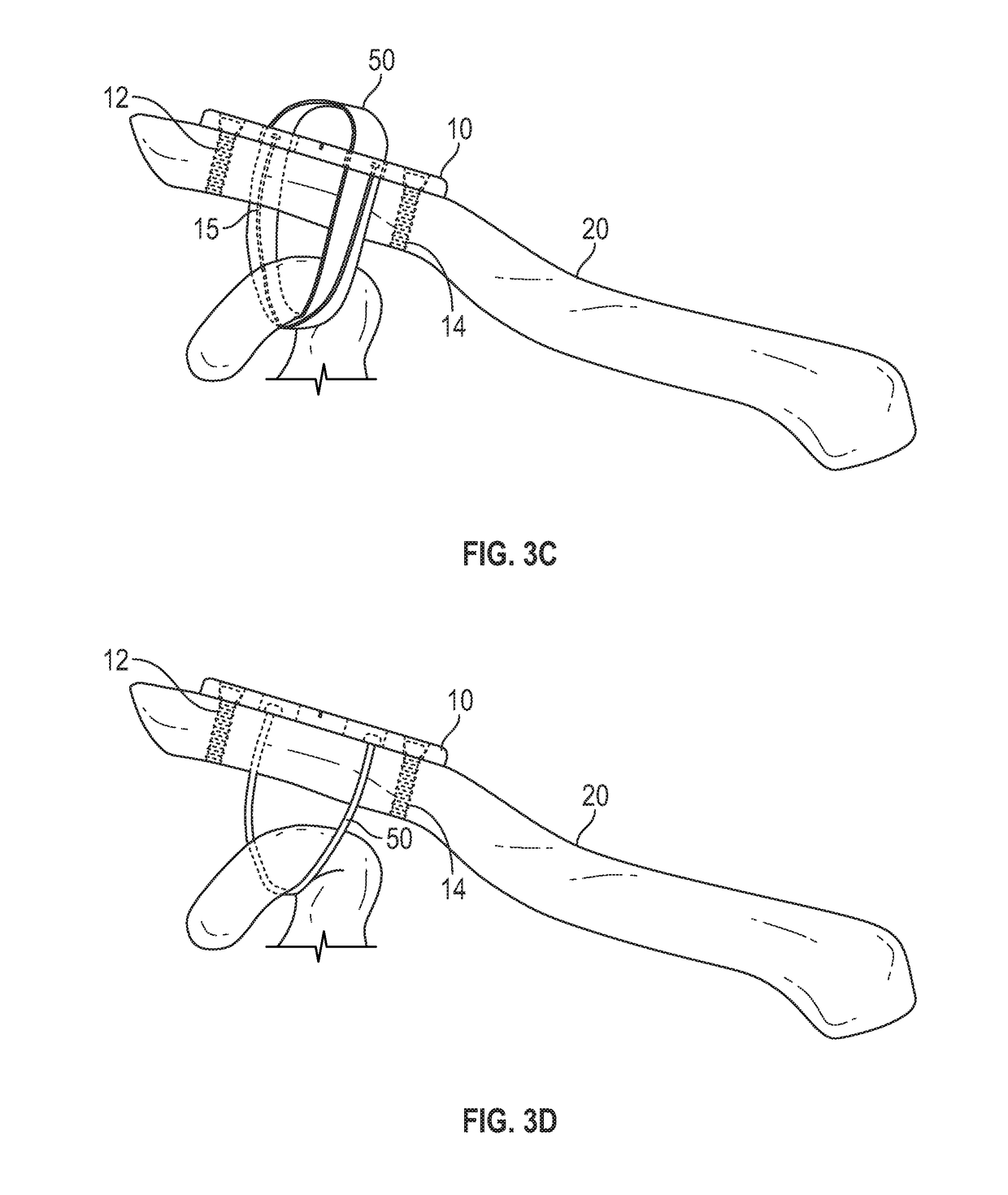 Device for and method of treating acromioclavicular joint dislocations