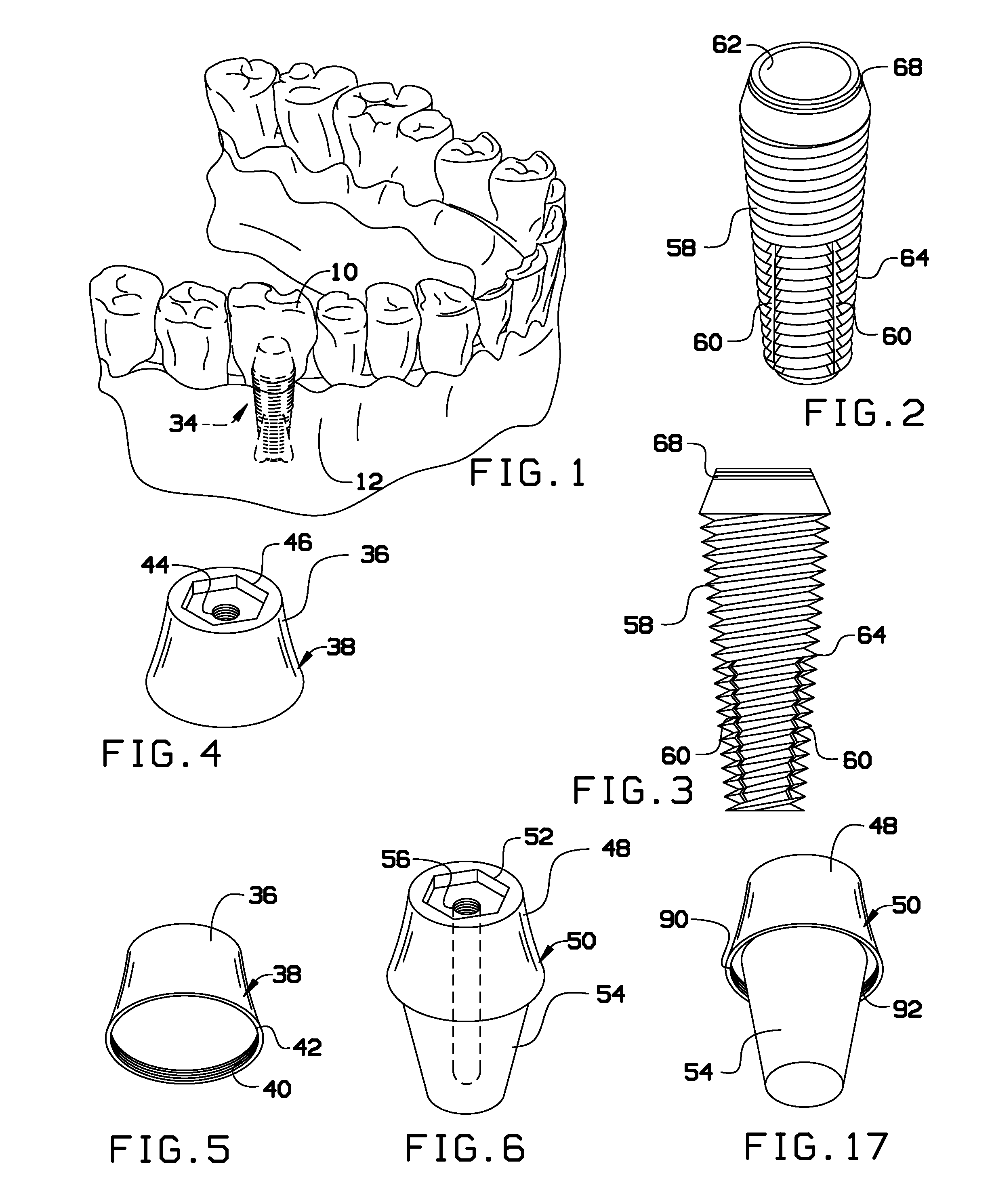 Dental implant system