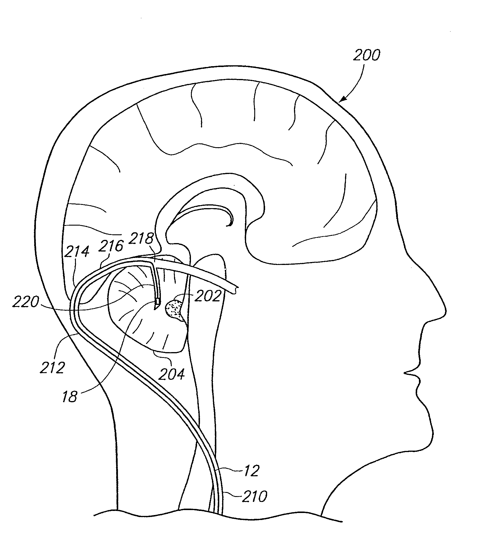 Method of stimulating fastigium nucleus to treat neurological disorders