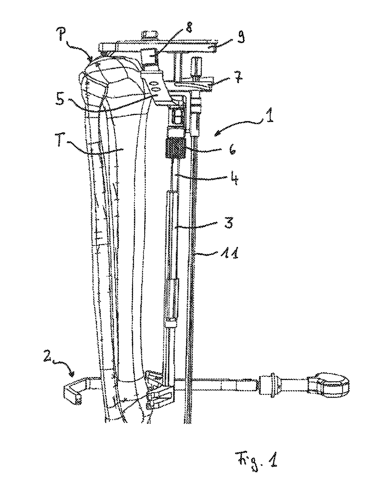 Device for defining a cutting plane for a bone resection