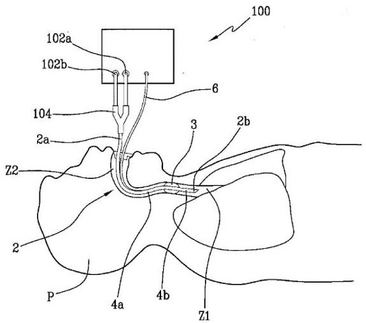 Devices for controlling the pressure of the endotracheal cuff and positive pressure ventilators