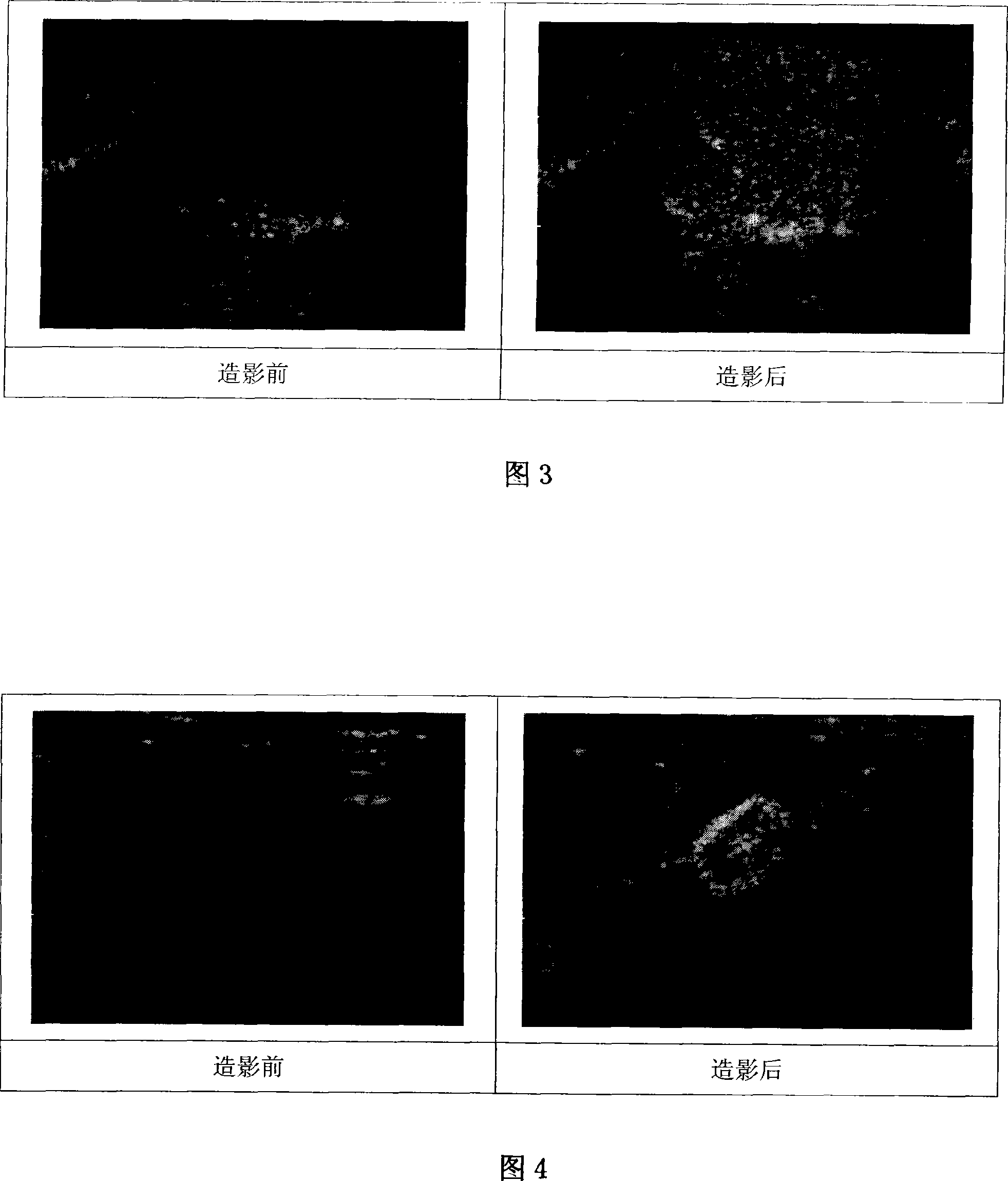 Lipid microvesicle ultrasound angiography powder agent internally containing mixture gas of fluorine carbon/nitrogen gas and production of the same