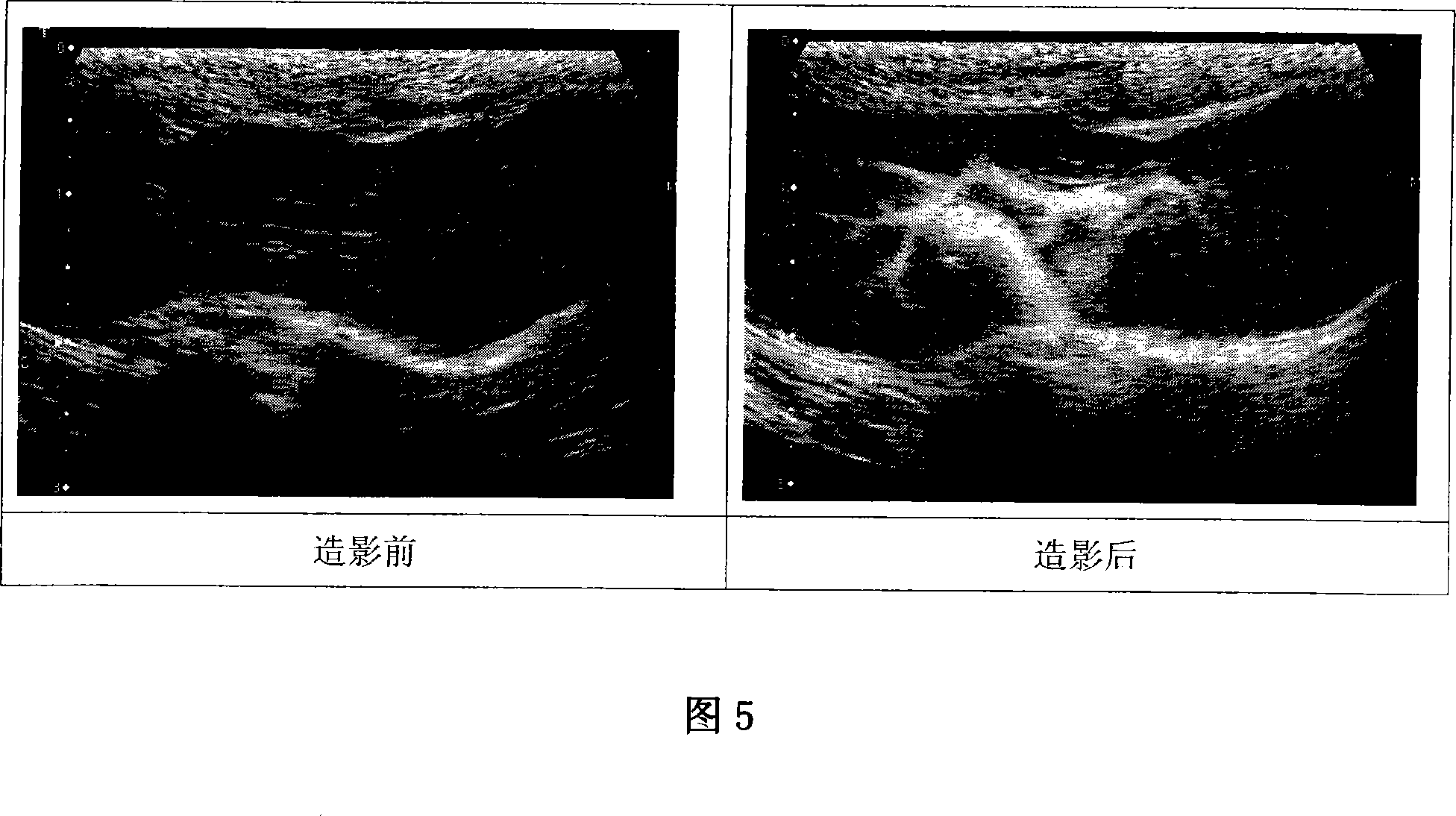 Lipid microvesicle ultrasound angiography powder agent internally containing mixture gas of fluorine carbon/nitrogen gas and production of the same