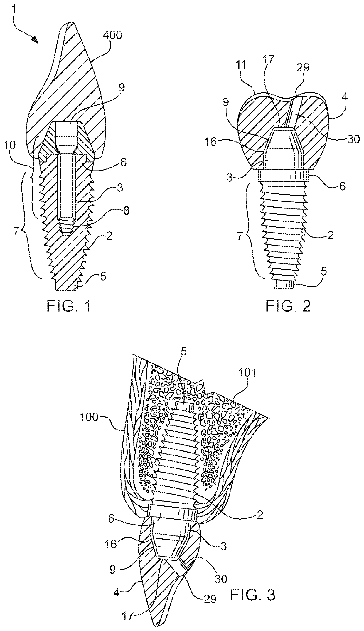 Cemented dental crown removal system