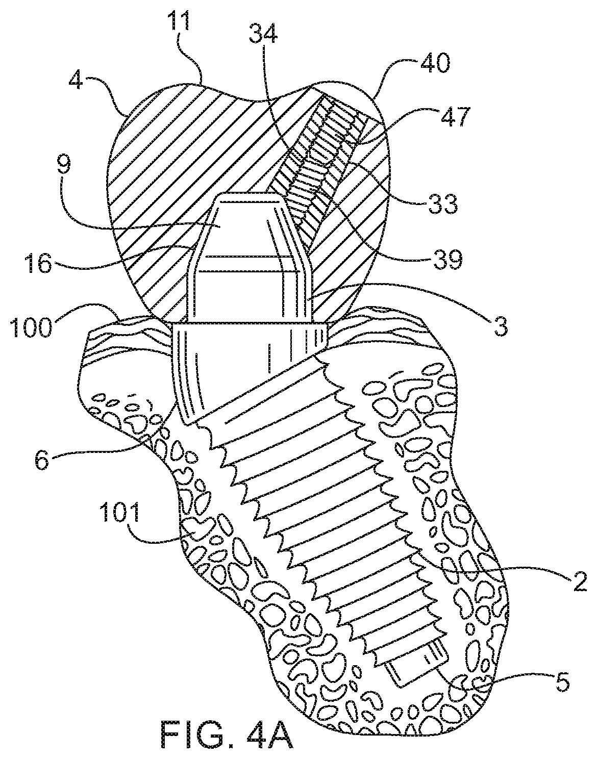 Cemented dental crown removal system