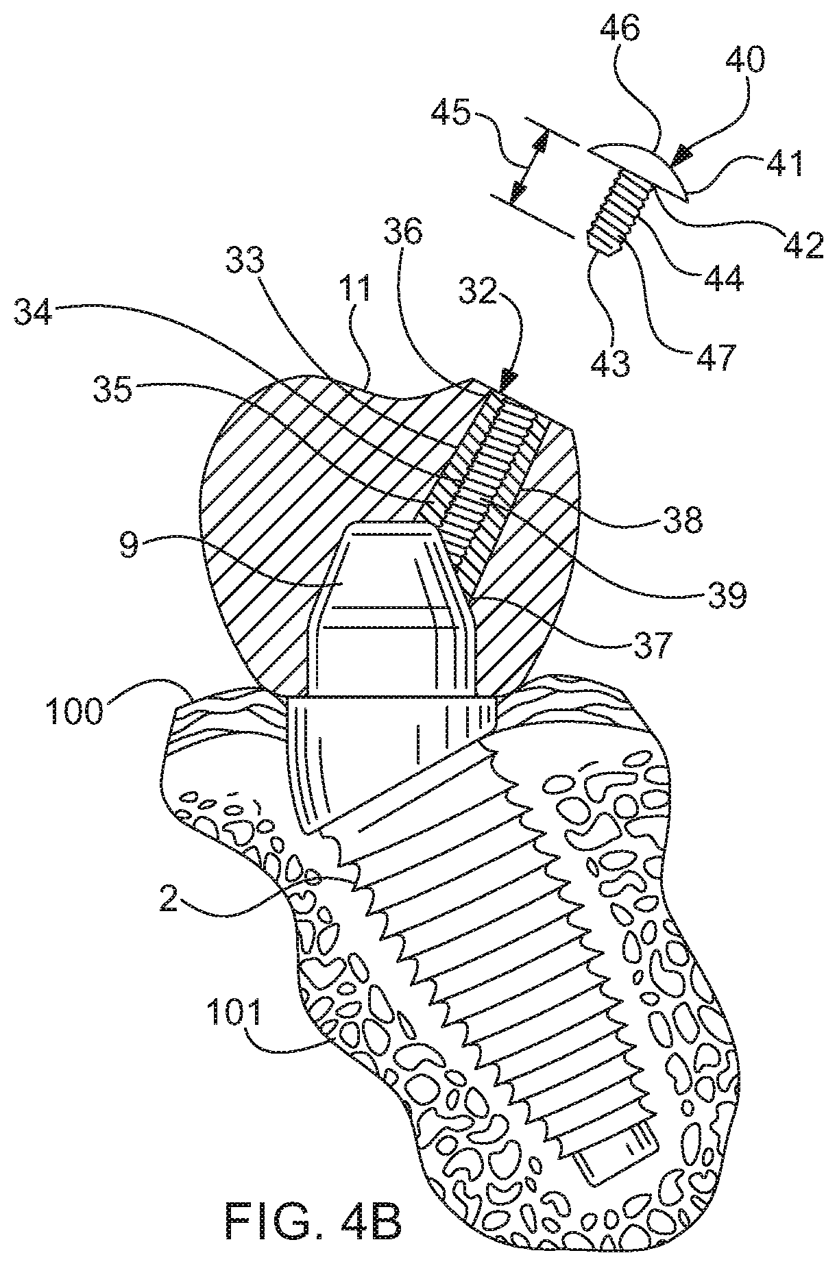 Cemented dental crown removal system