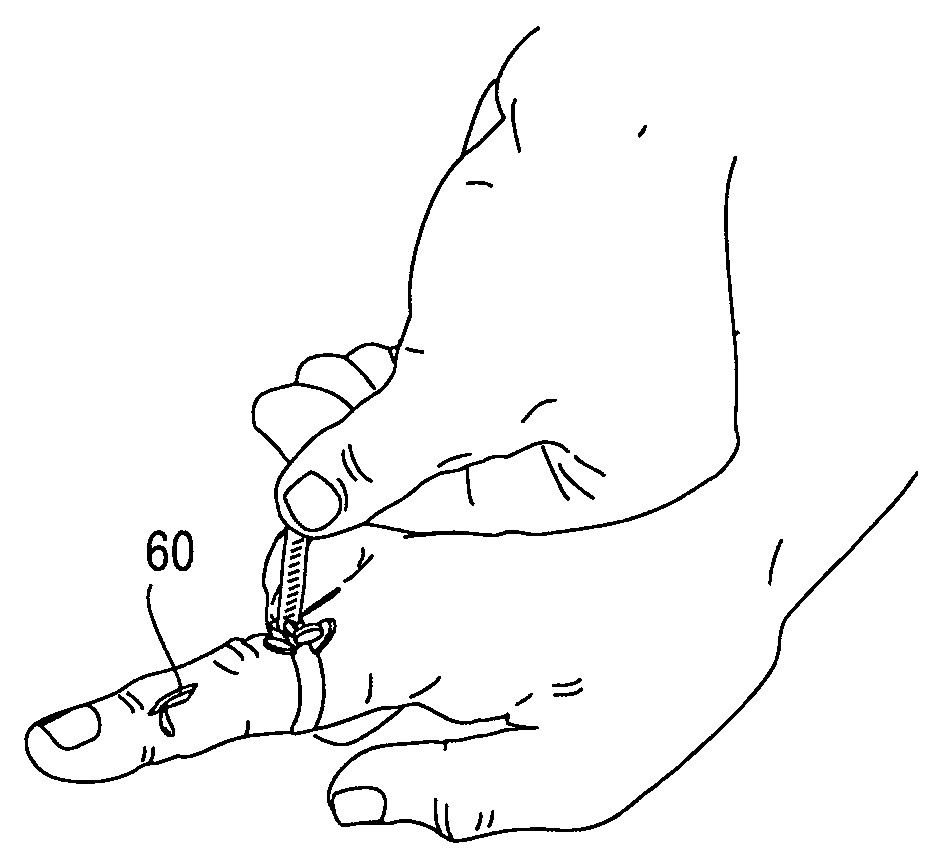 Method and apparatus for restricting blood flow