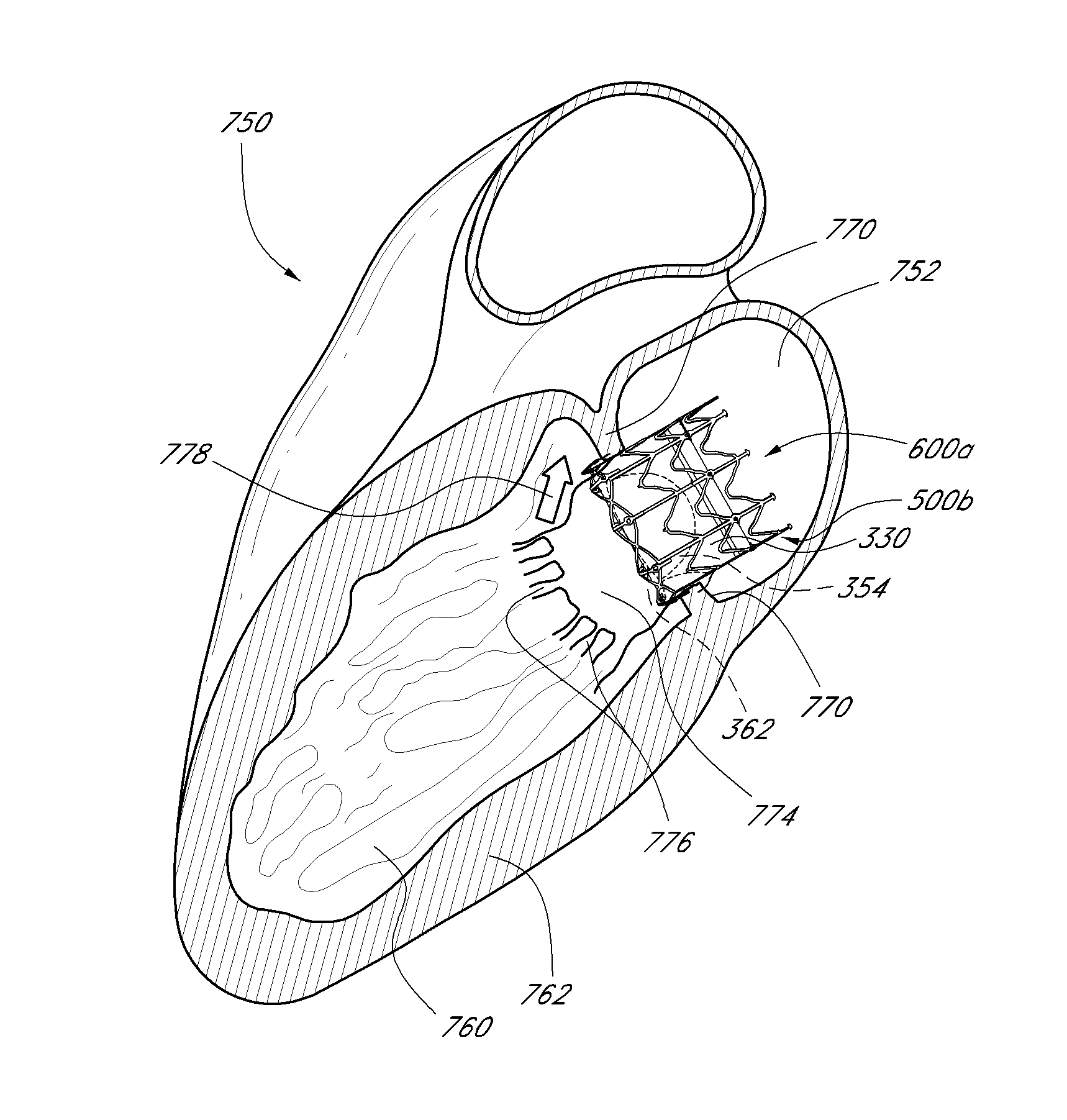 Replacement heart valve and method