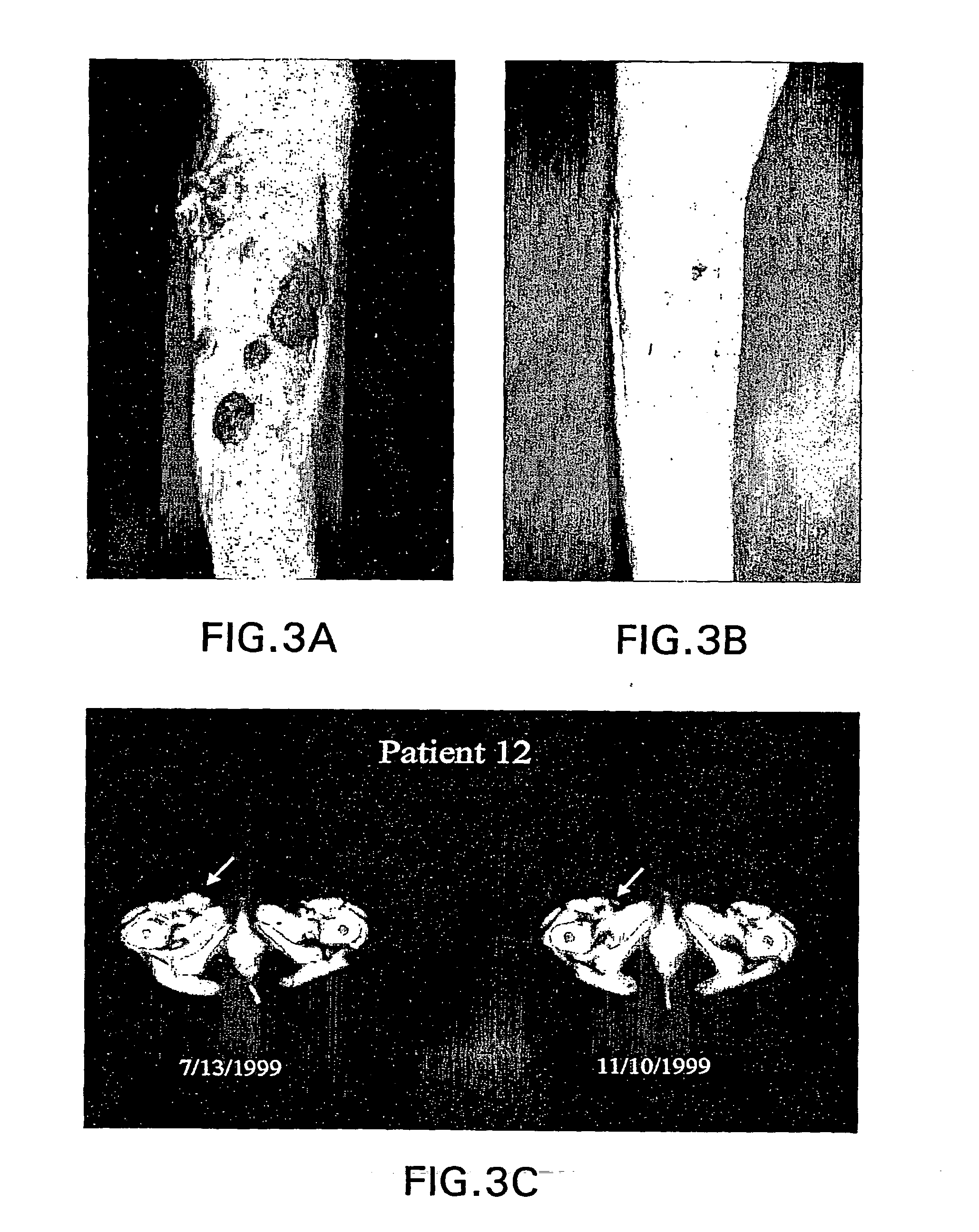 Methods of treatment of a bcl-2 disorder using bcl-2 antisense oligomers