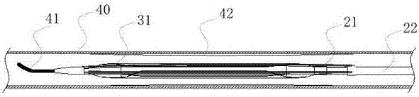 Cutting device for blood vessel plaque