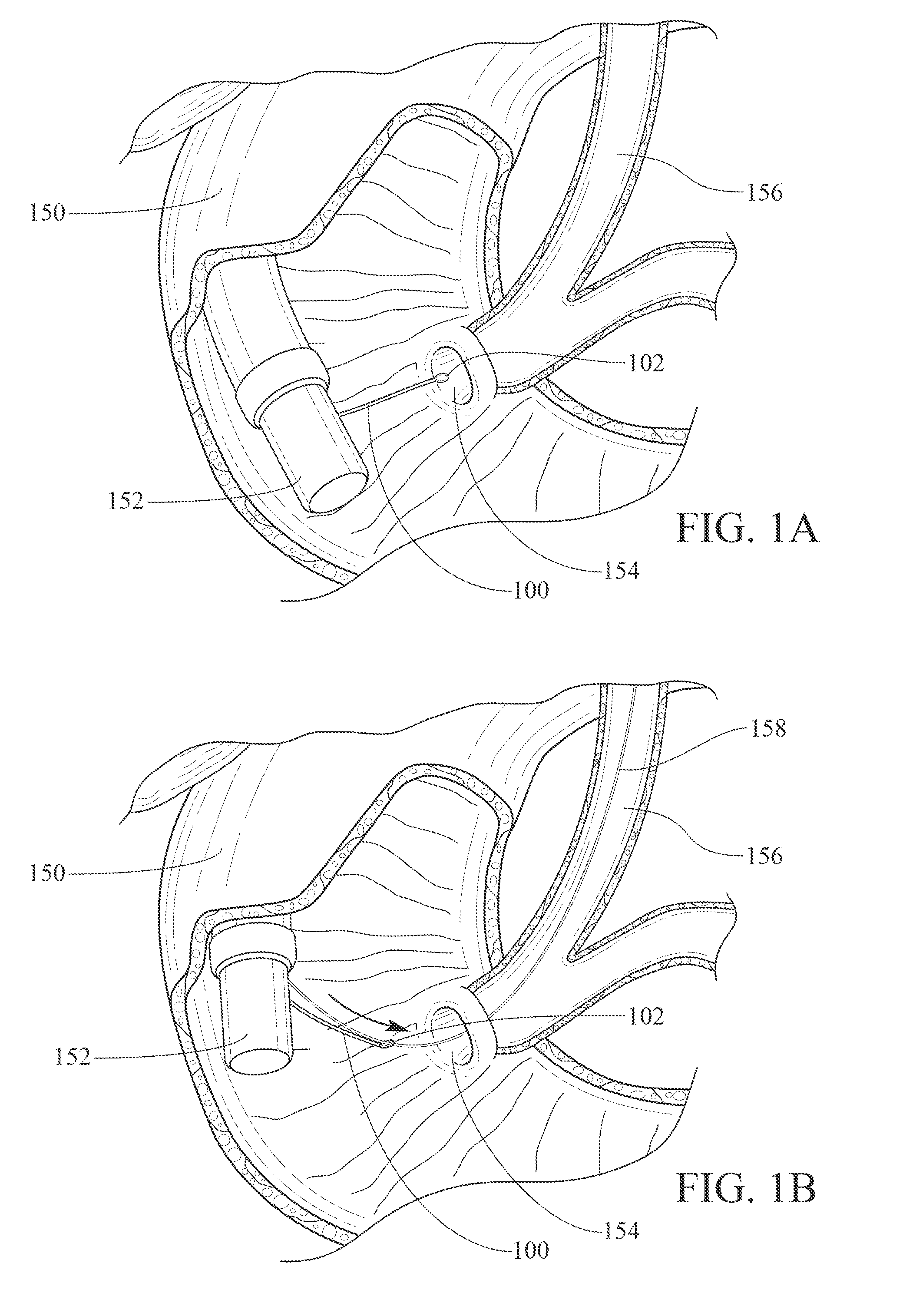 Balloon catheter with detachable hub, and methods for same