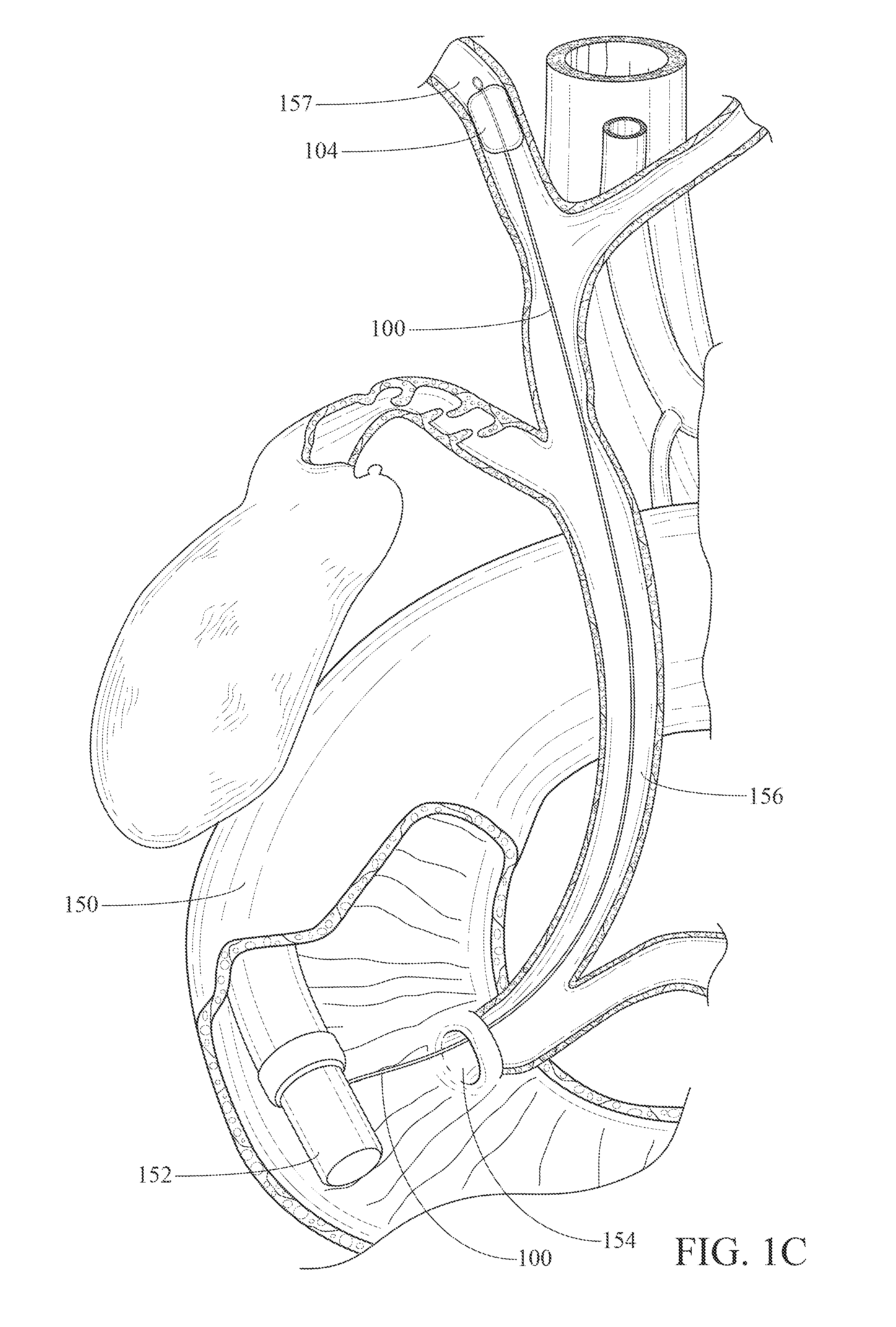 Balloon catheter with detachable hub, and methods for same