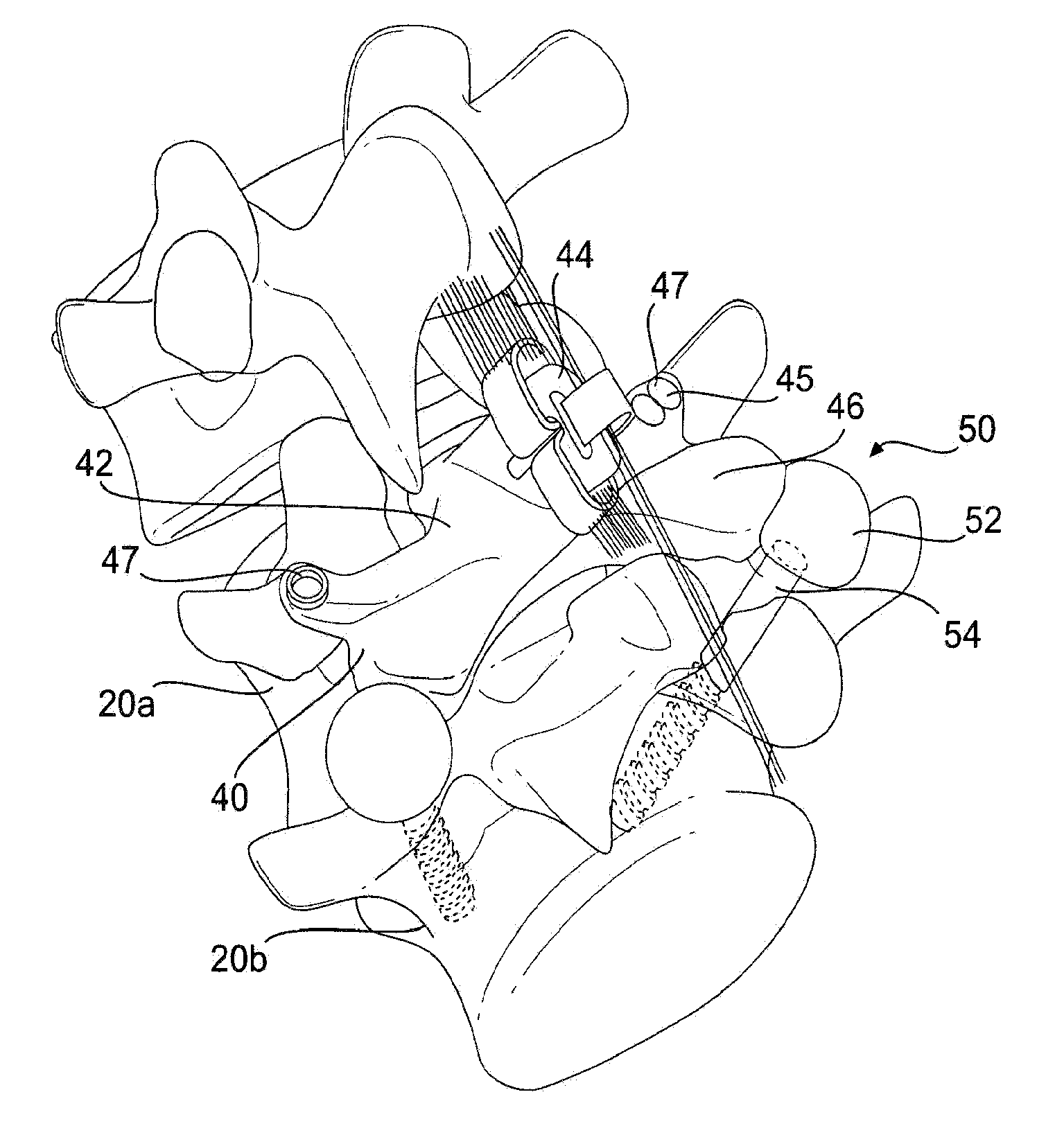 Prosthesis and Method for Replacing Degenerative Vertebral Portions