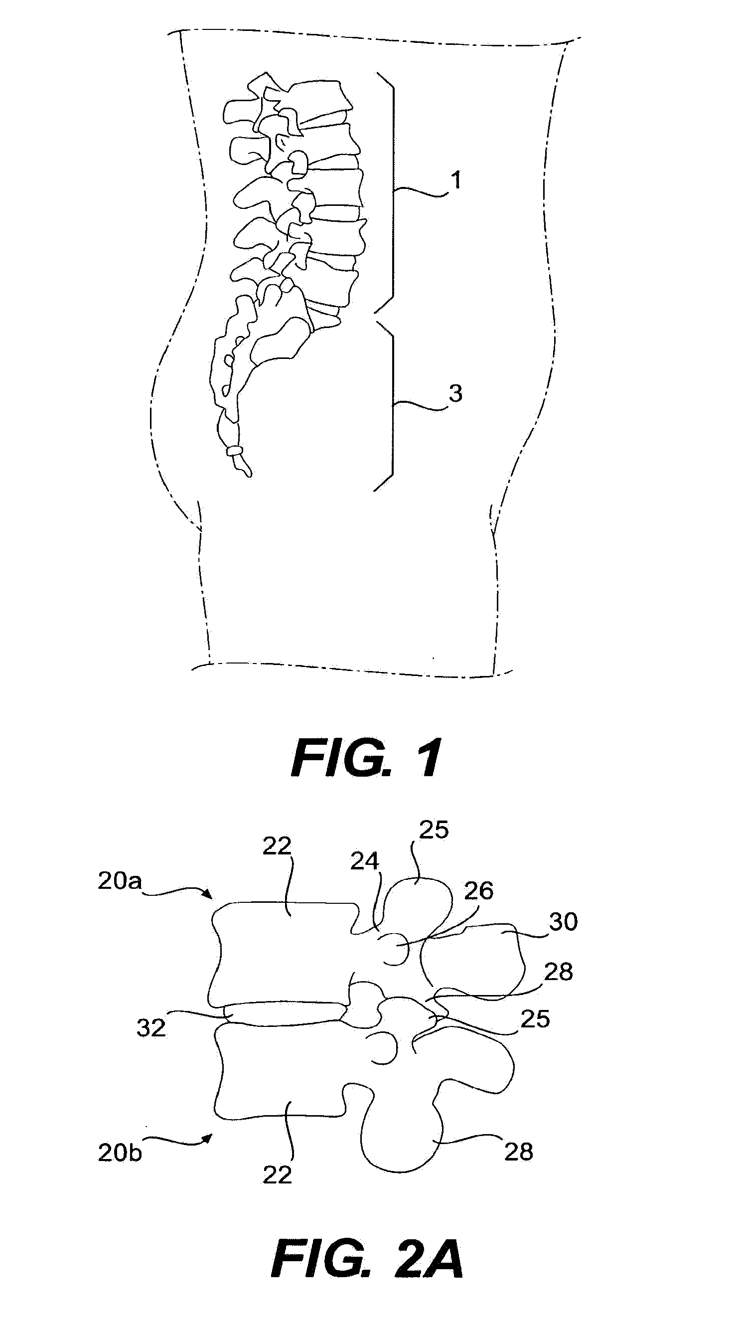 Prosthesis and Method for Replacing Degenerative Vertebral Portions