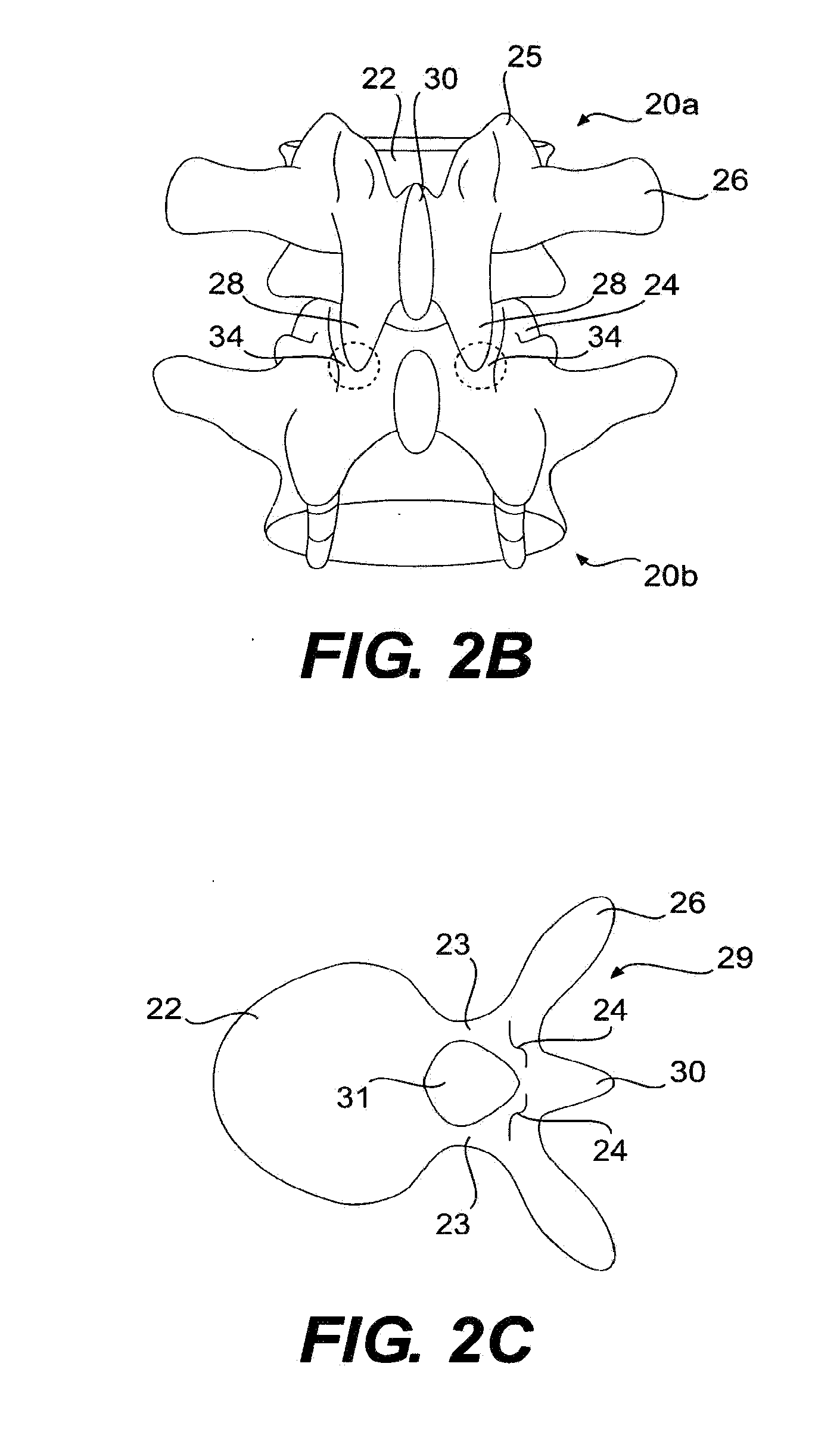 Prosthesis and Method for Replacing Degenerative Vertebral Portions