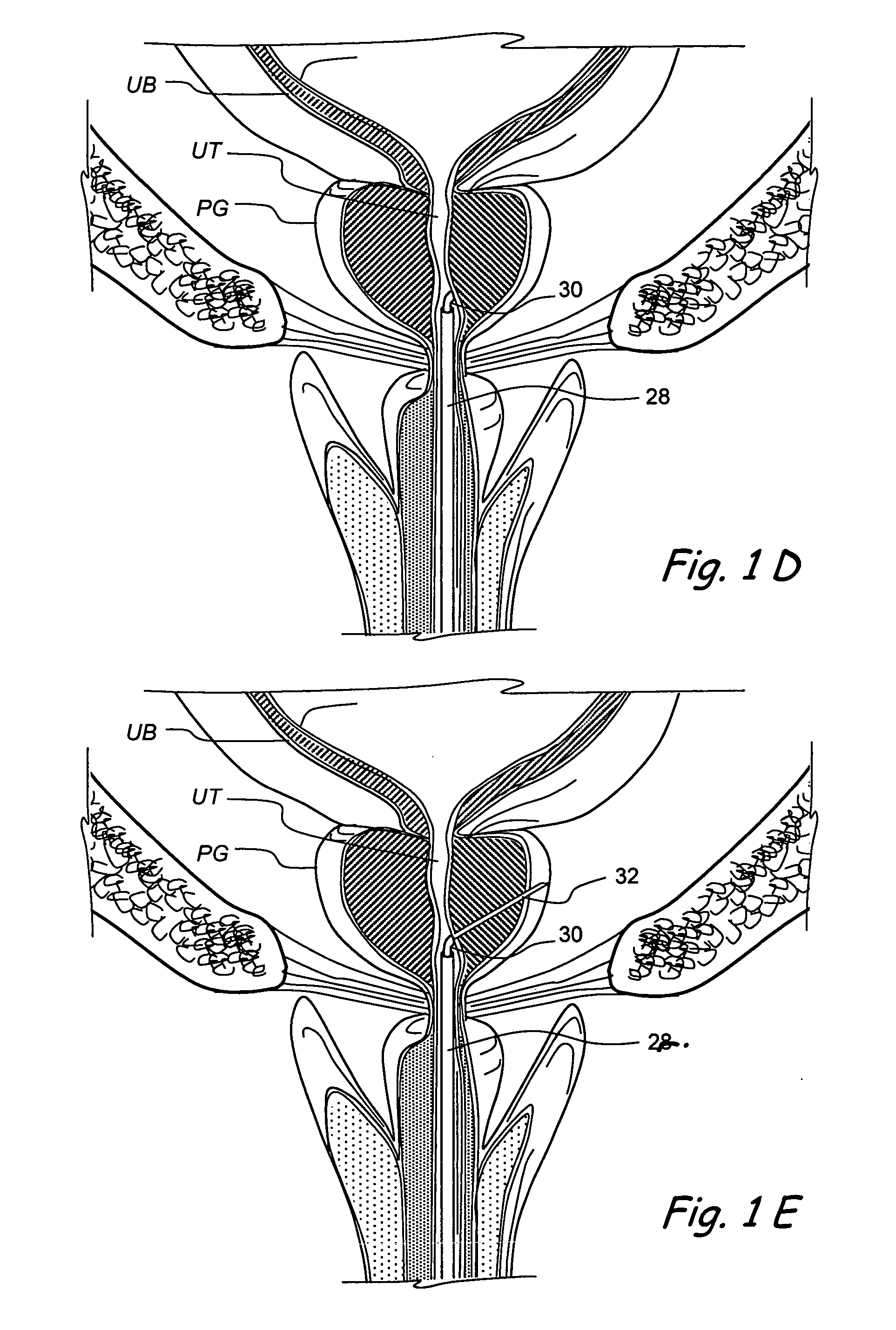 Devices, systems and methods for retracting, lifting, compressing, supporting or repositioning tissues or anatomical structures