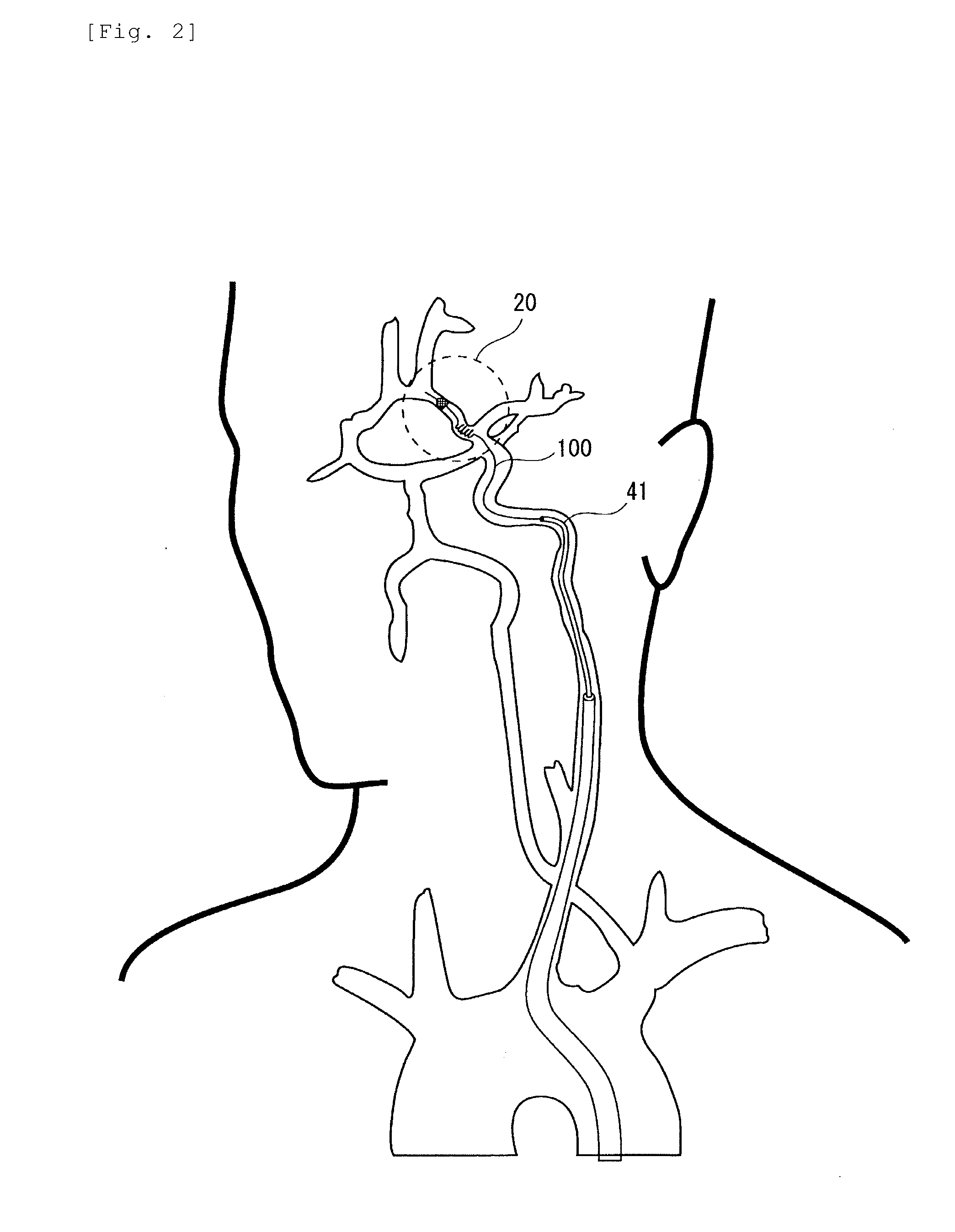 Embolic material excision trapping device