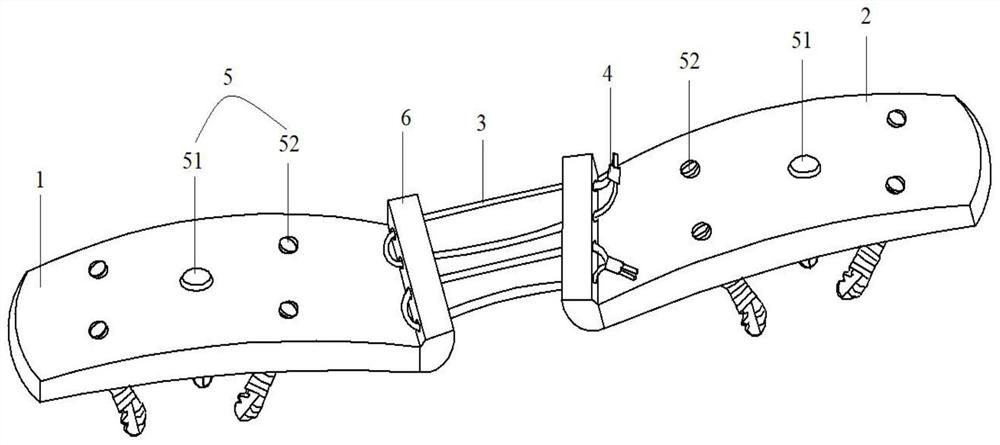 Elastic fixation device for acromioclavicular joint